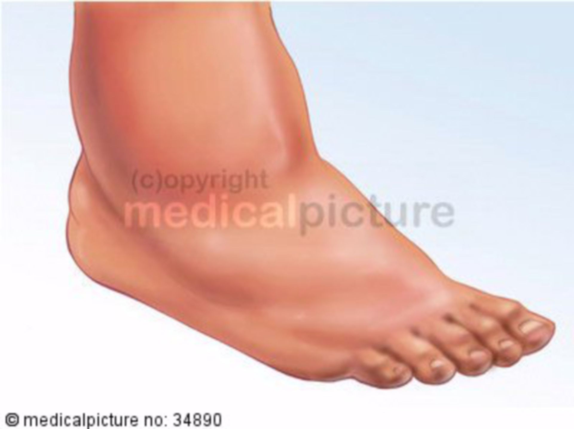 Diabetic foot syndrome Charcot foot