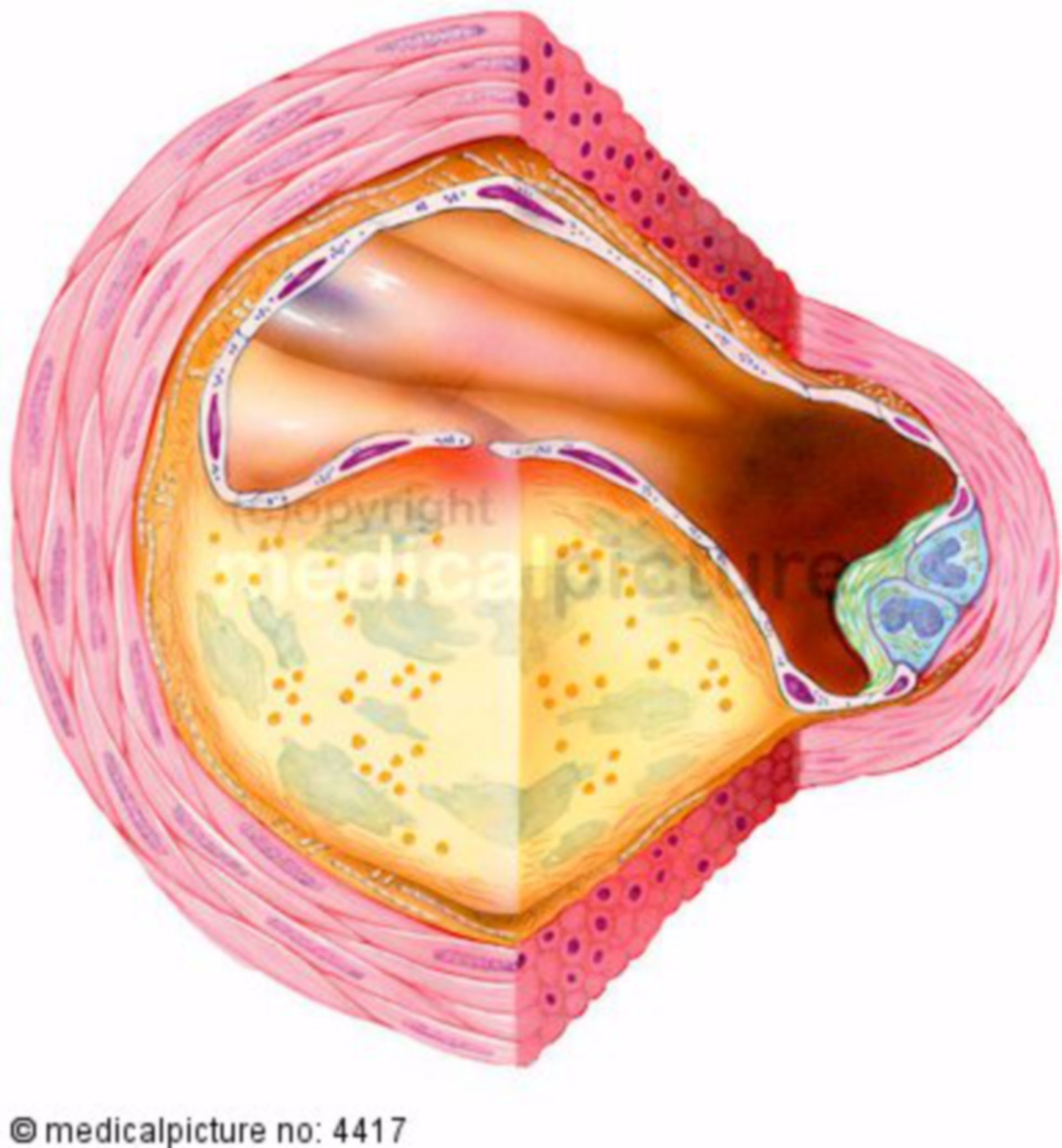 Artery with atherosclerosis, arterial wall