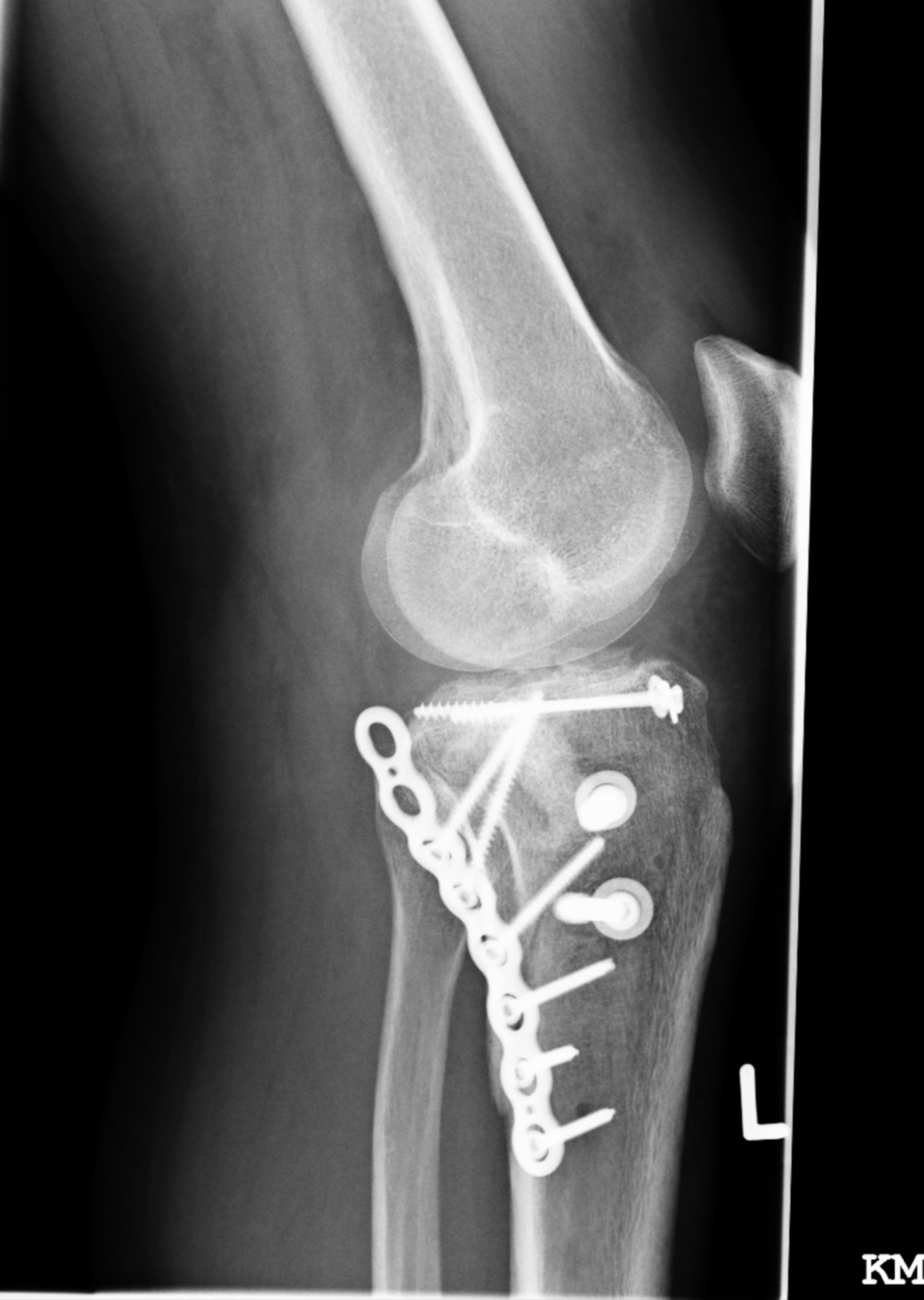 Tibia head fracture- osteosynthesis