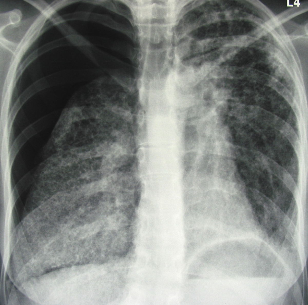Pneumothorax rechts bei Lungenfibrose