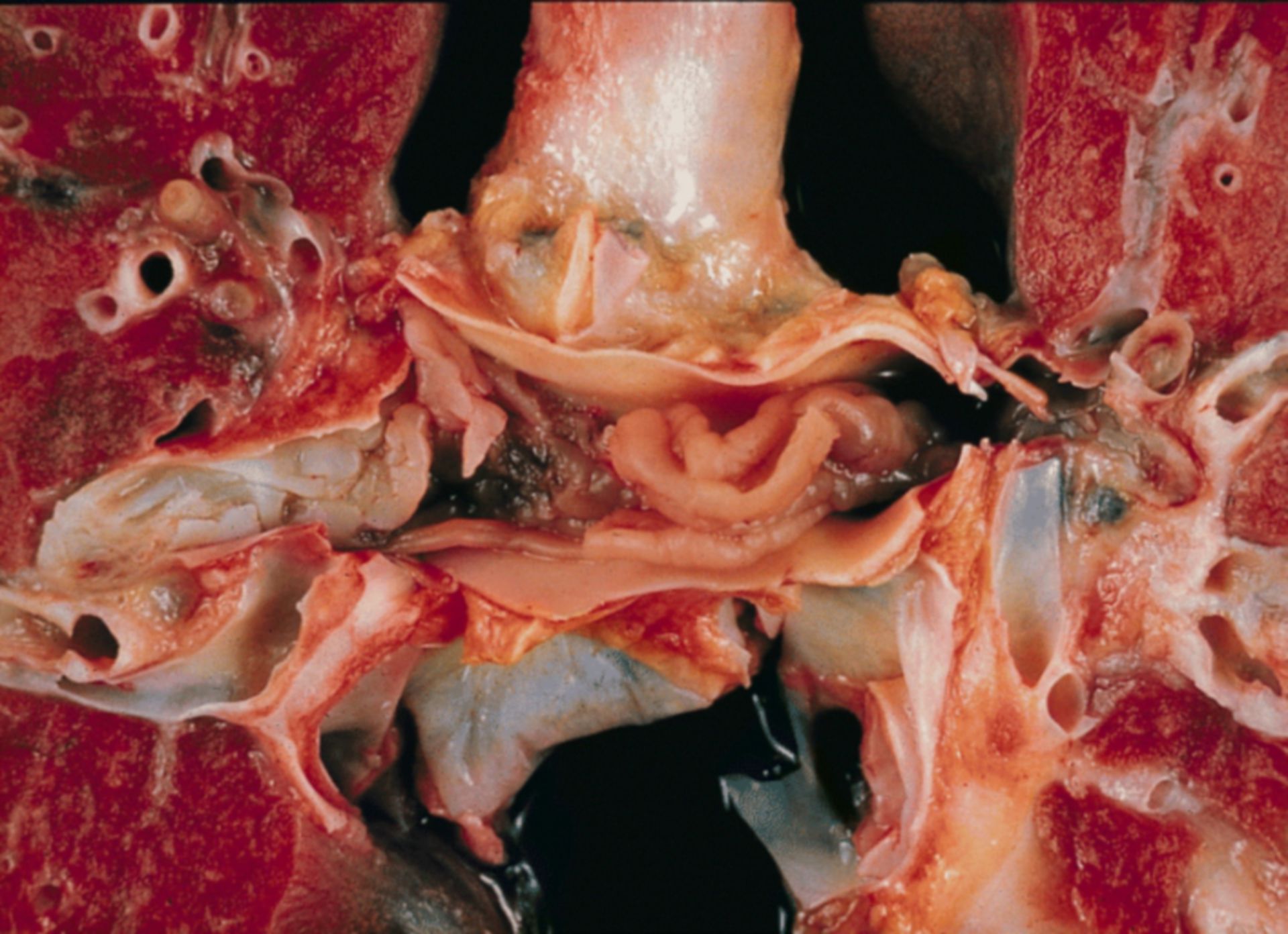 Lower respiratory tract: intra-arterial metastasis to the main pulmon