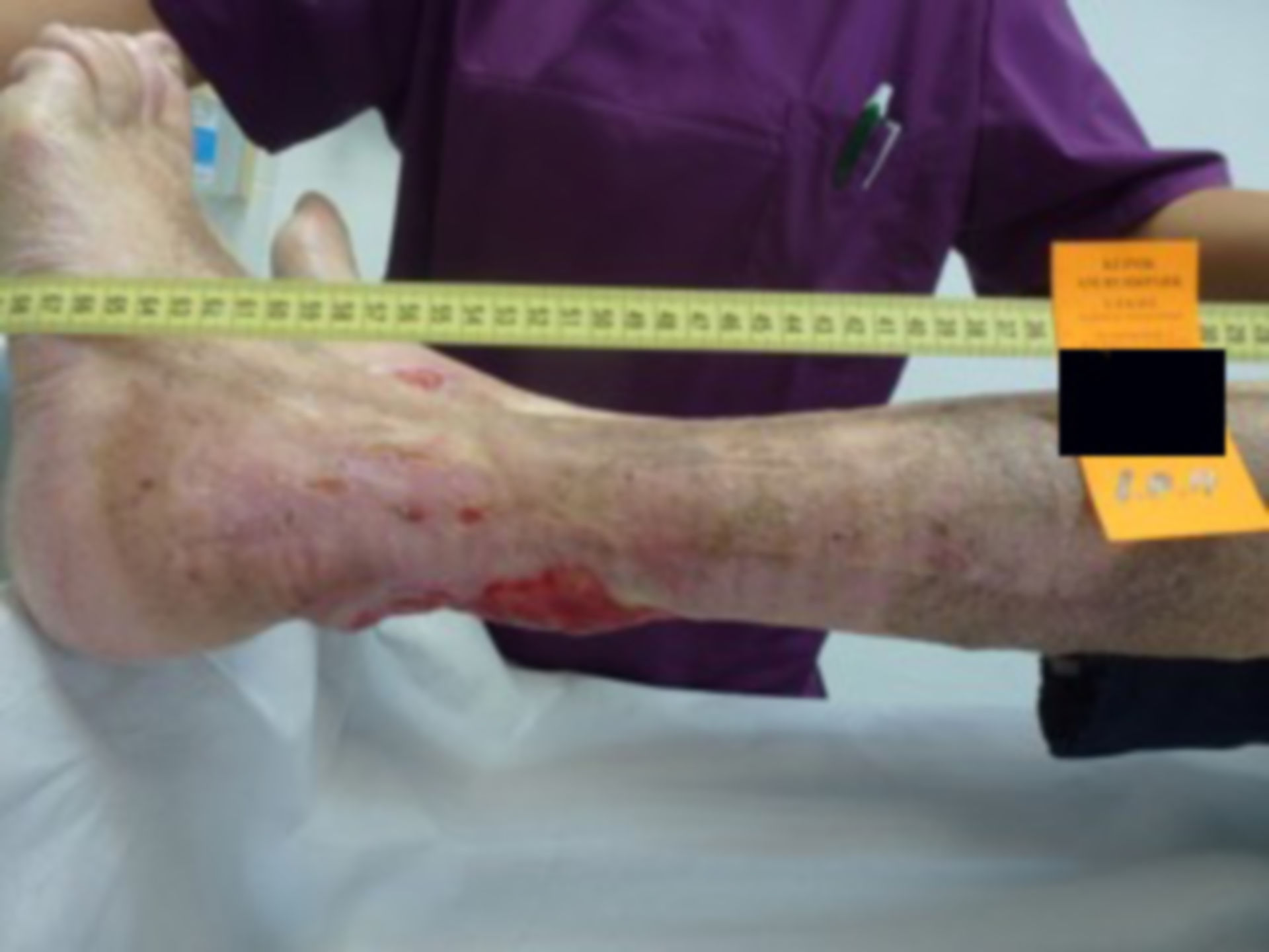 Ulcer of the lower leg - open for 40 years (30)