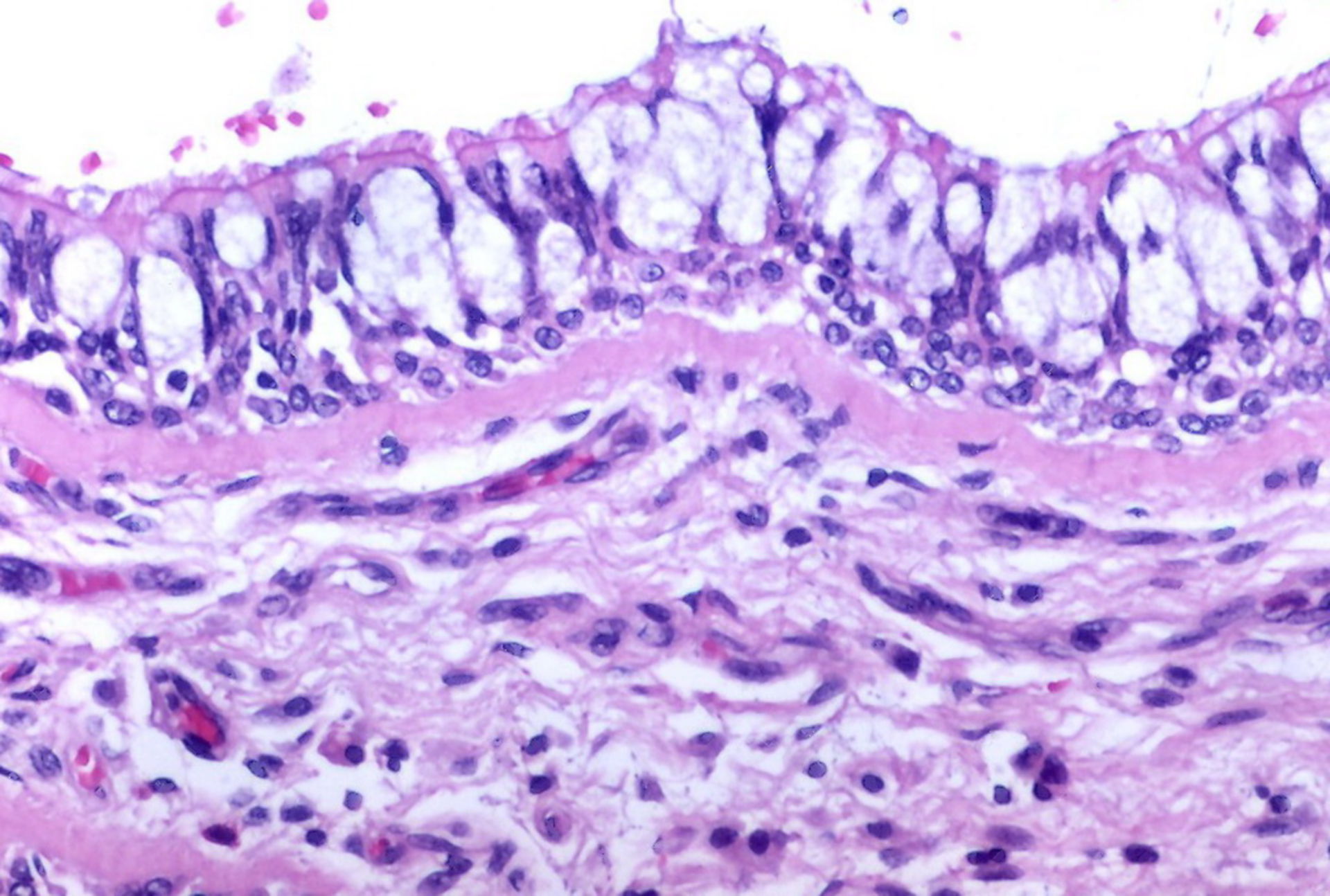 Bronchiale Becherzellen-Hyperplasie (Histologie)