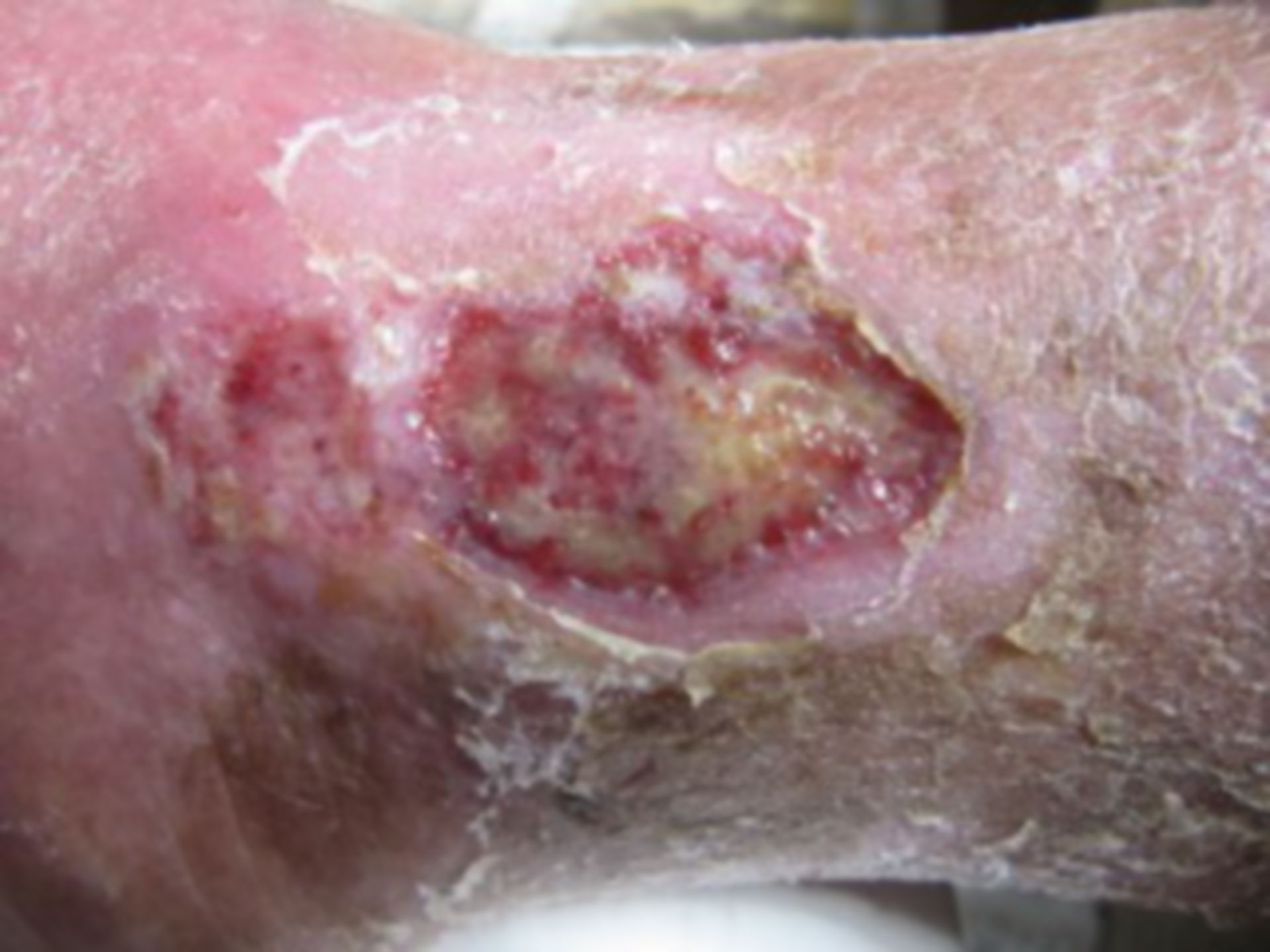 Úlcera de la pierna - abierta por 18 meses (5)