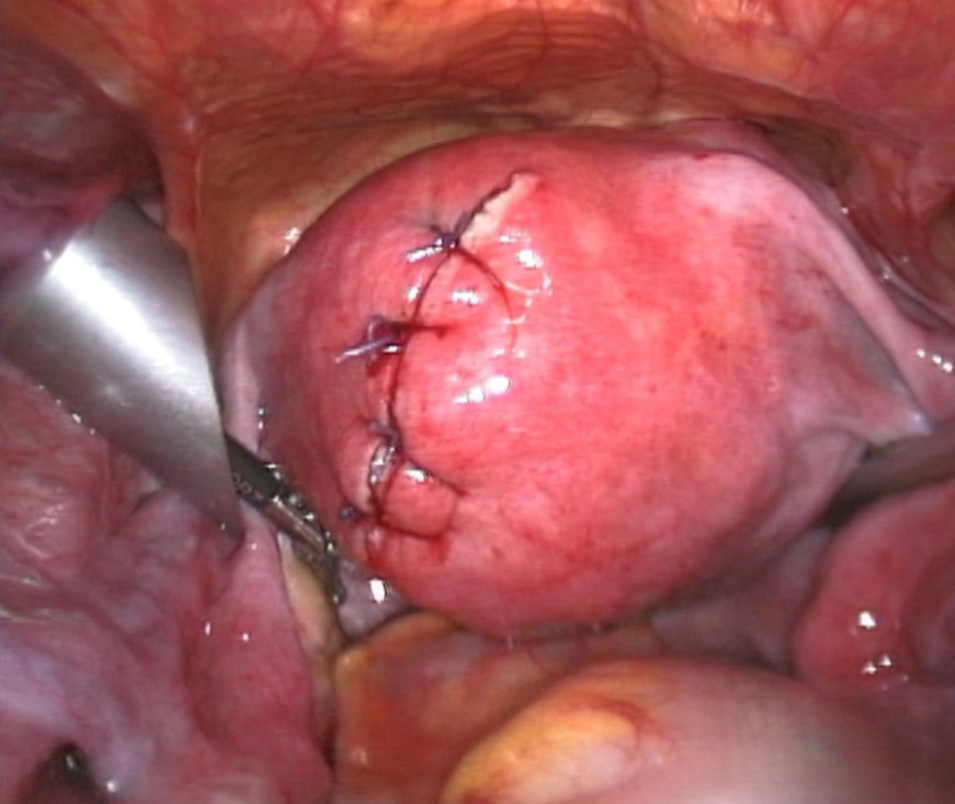 Sutured uterus wound after myomectomy