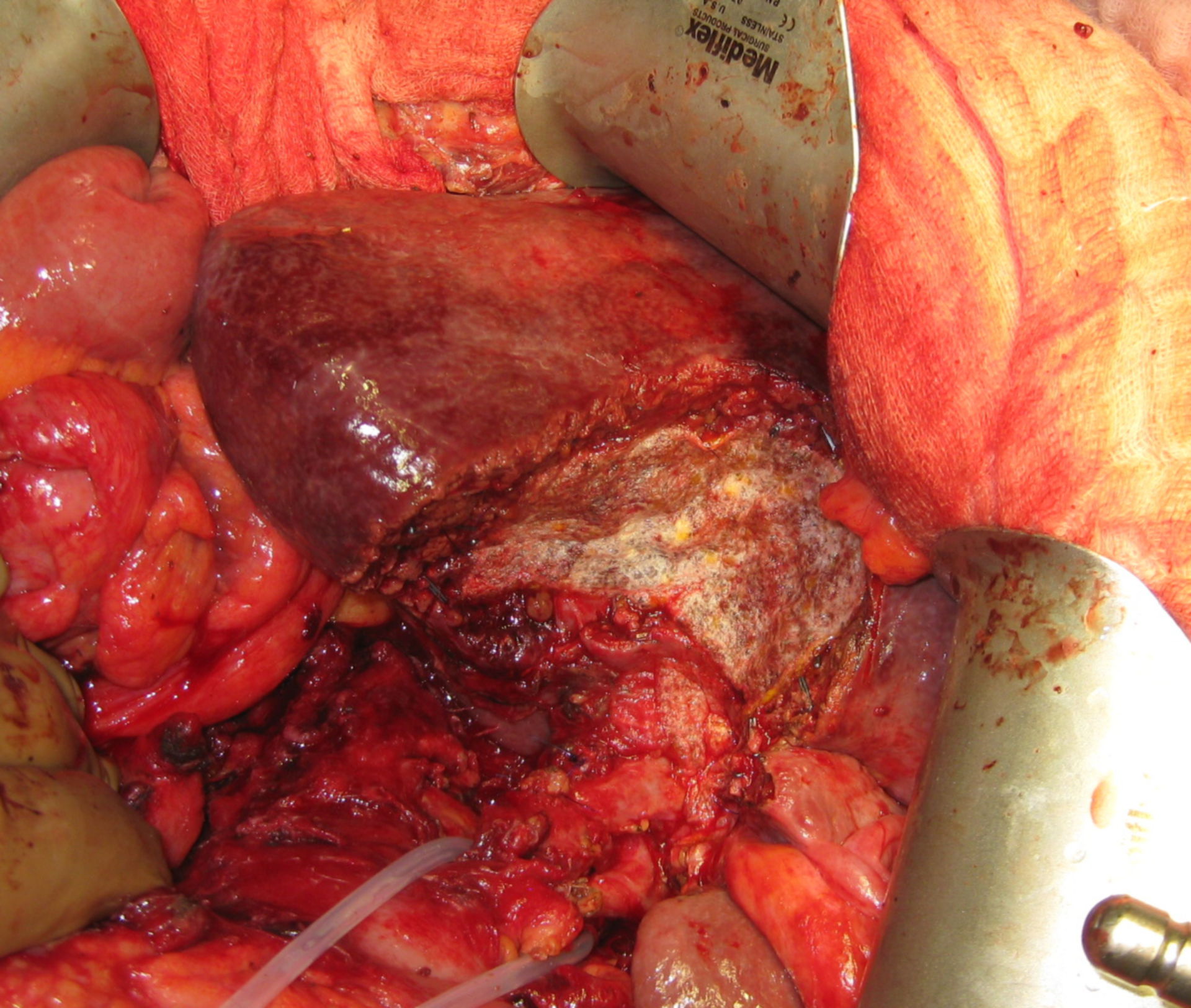 Partial liver resection because of a carcinoma of the gall bladder