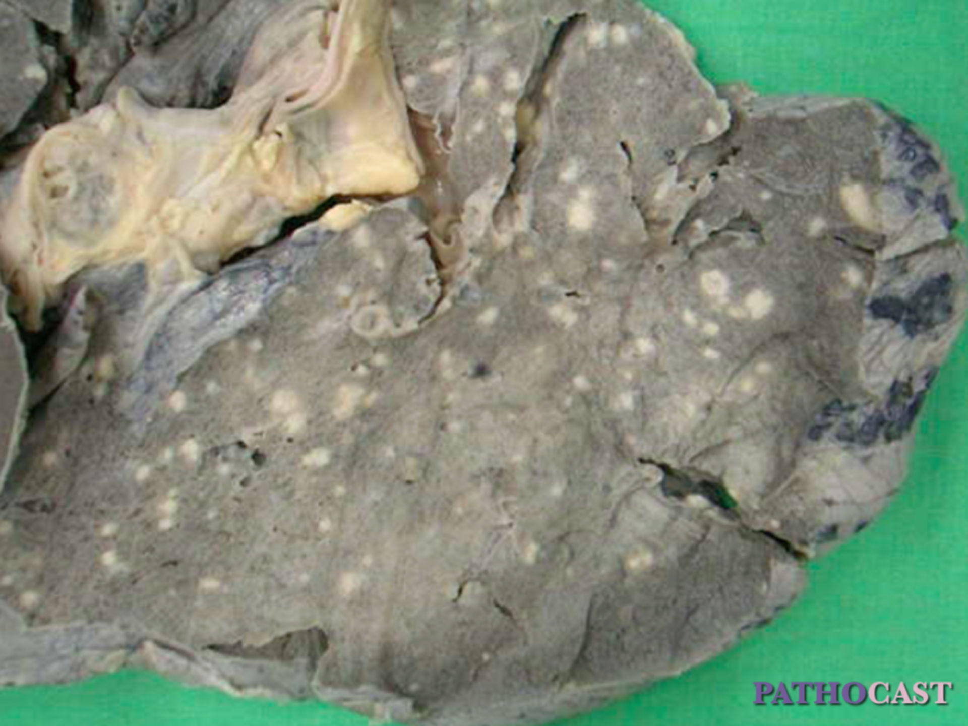 Miliartuberkulose der Lunge, Makroskopie