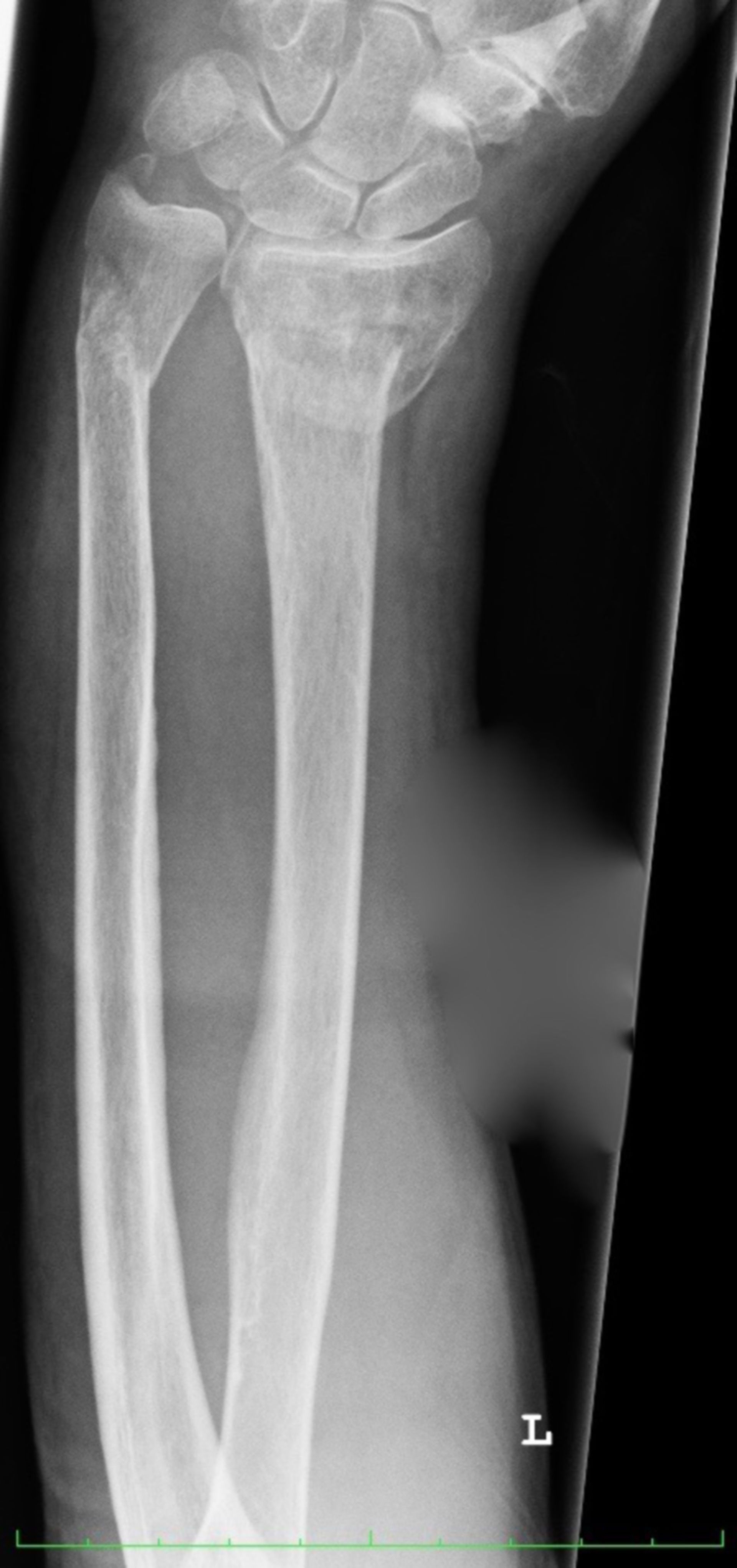 Röntgen des kompletten Unterarmes links mit distaler Radius- und Ulnafraktur
