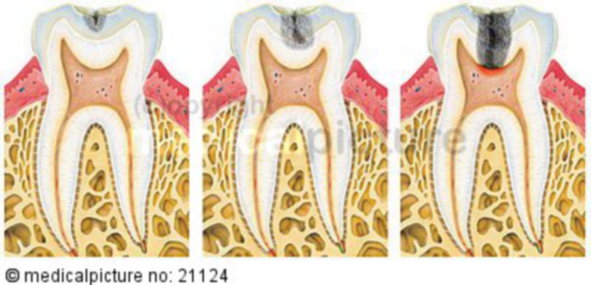  Karies befallener Zahn 
