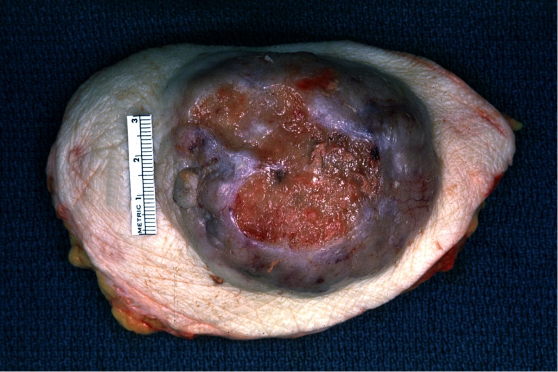 Breast cancer (adenocarcinoma, specimen)