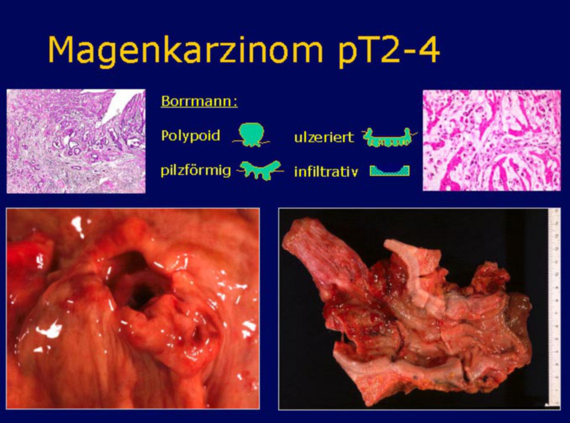 Macroscopic classification of stomach cancer afer Borrmann