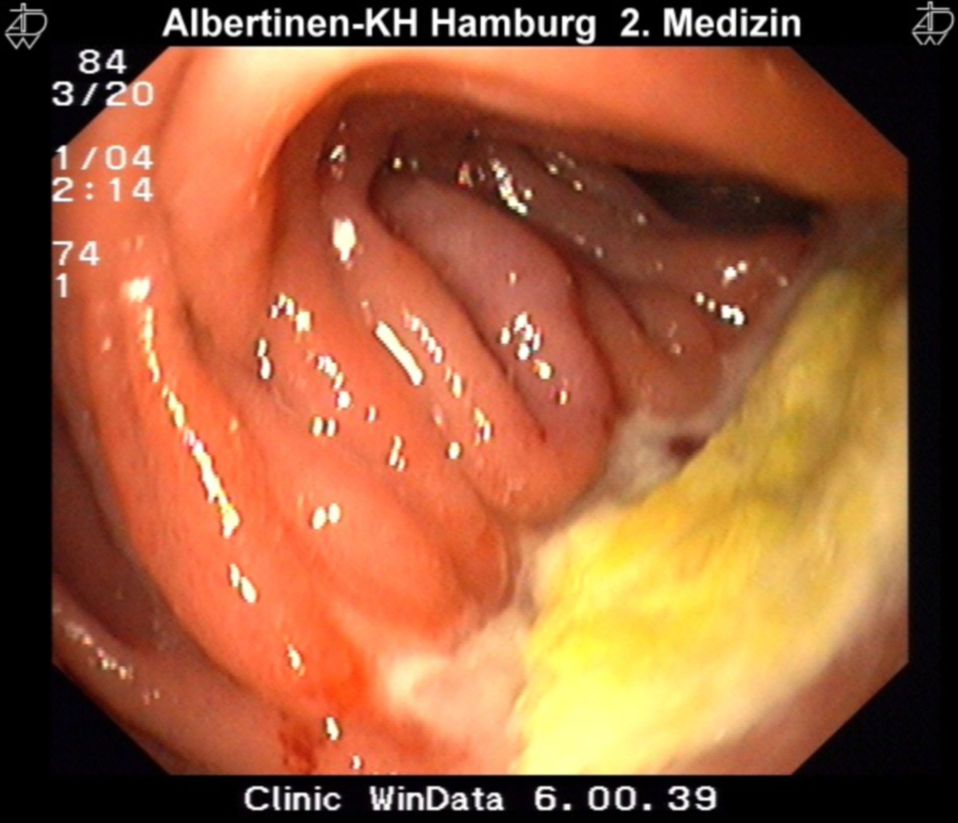 Anastomosis Ulcer