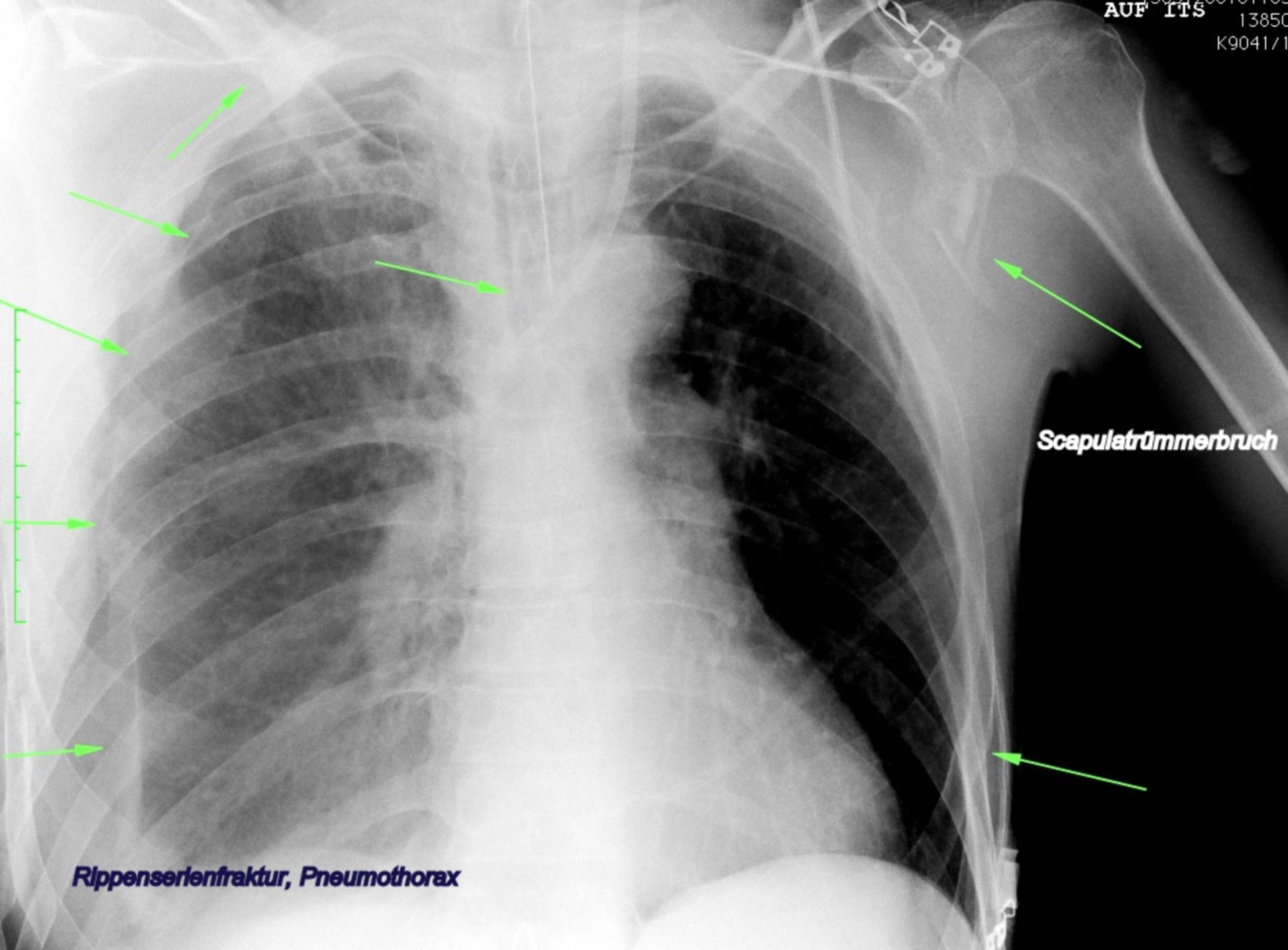 Serial rib fracture - Pneumothorax - Comminuted fracture of scapula left