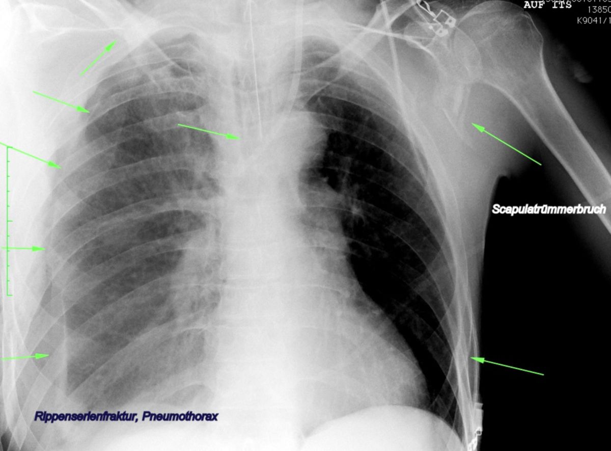 Rippenserienfraktur-Pneumothorax-Scapulatrümmerbruch links