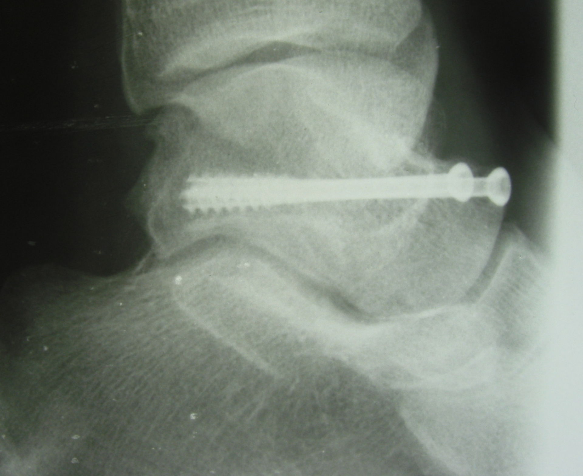 Talus fracture - screw osteosynthesis