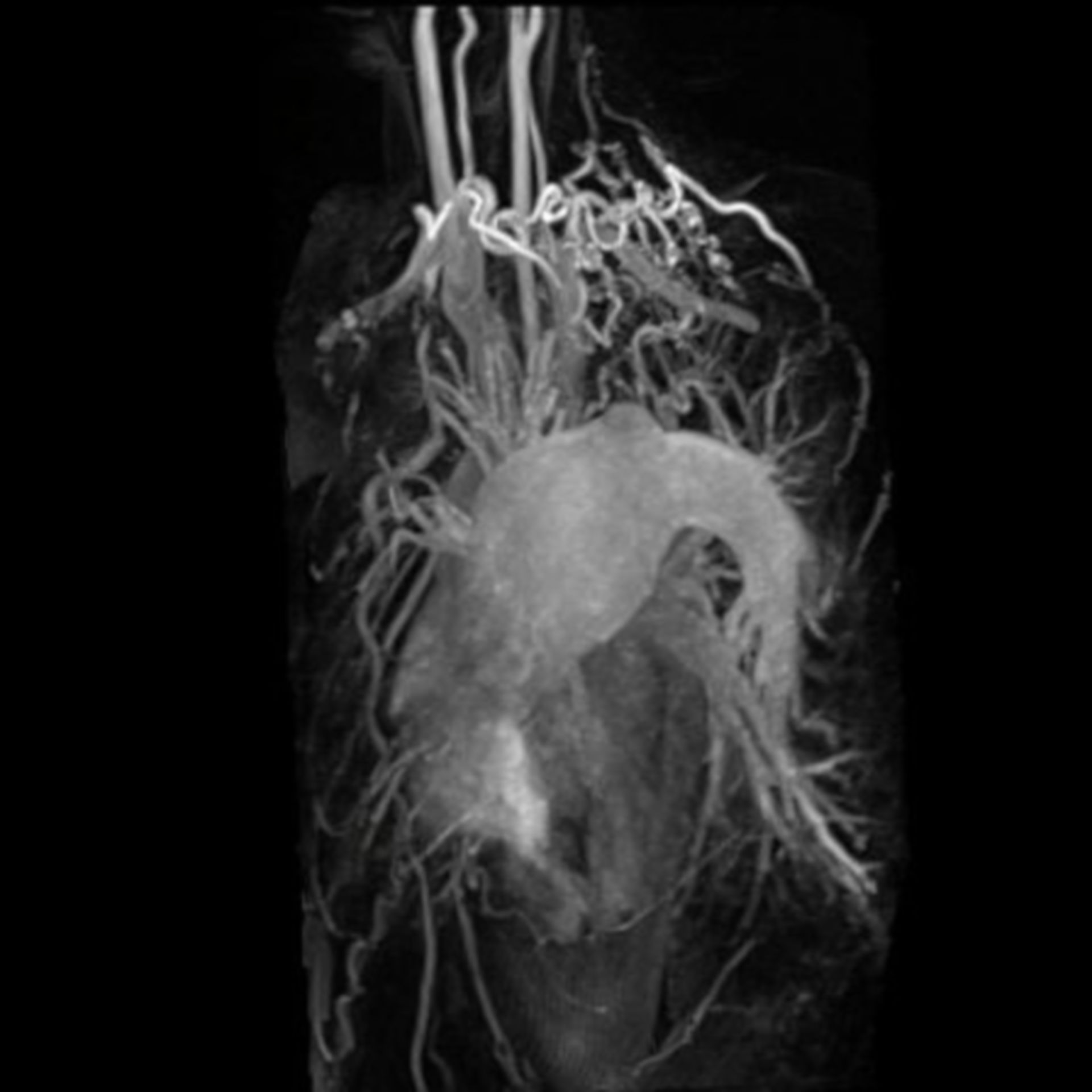 Angiografia dell' aorta e delle arterie carotidee