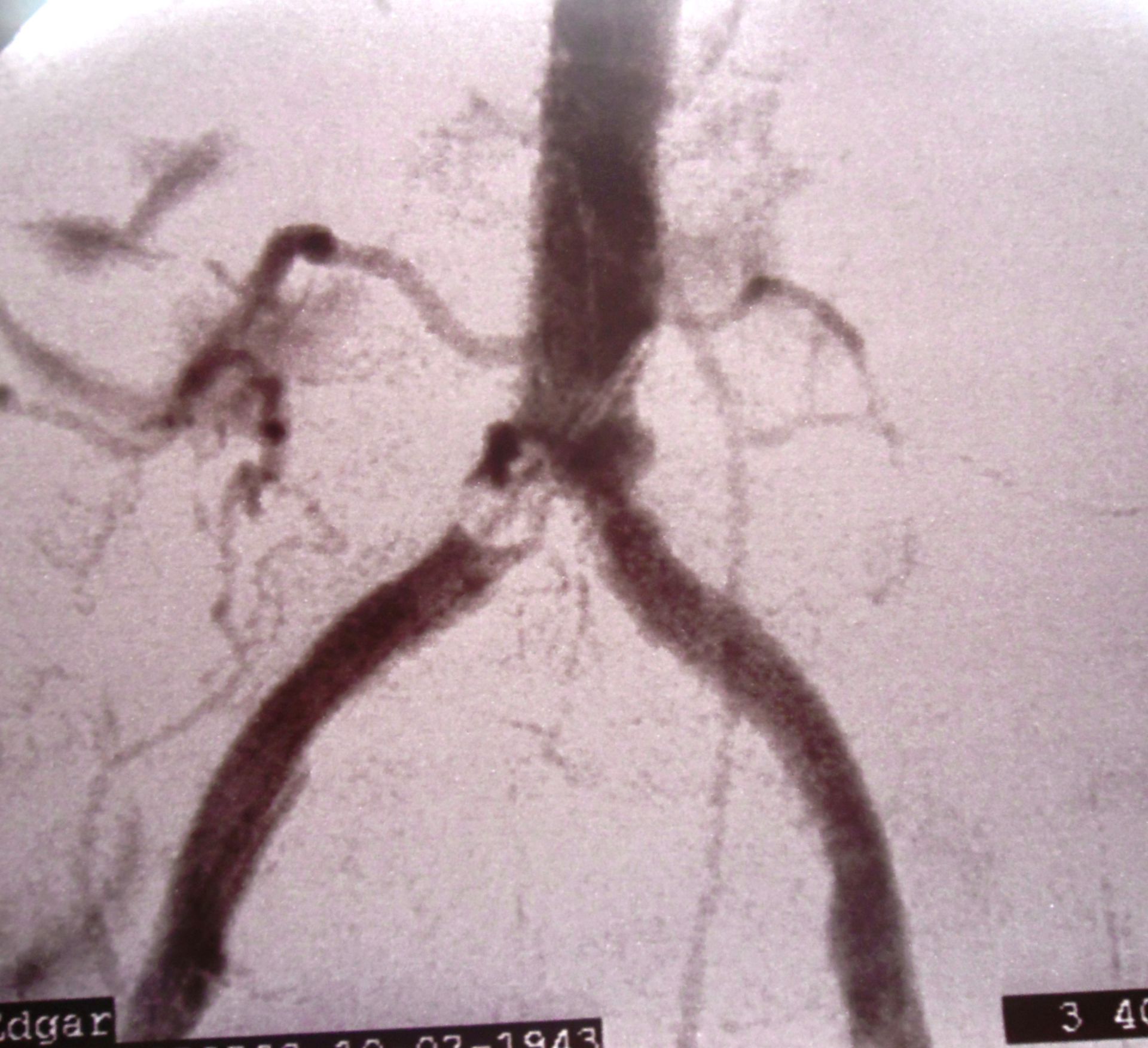 Arterielle Stenose der A. iliaca communis
