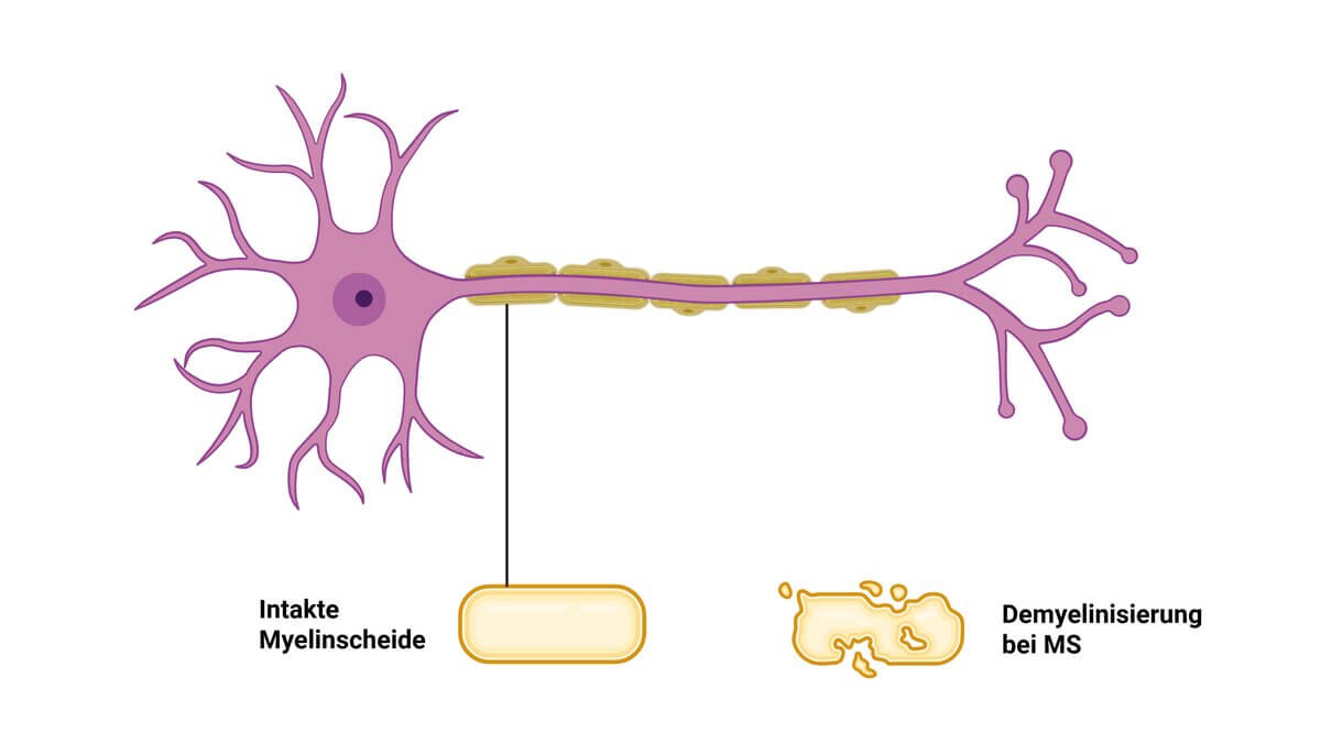 Pathophysiologie Demyelinisierung bei MS