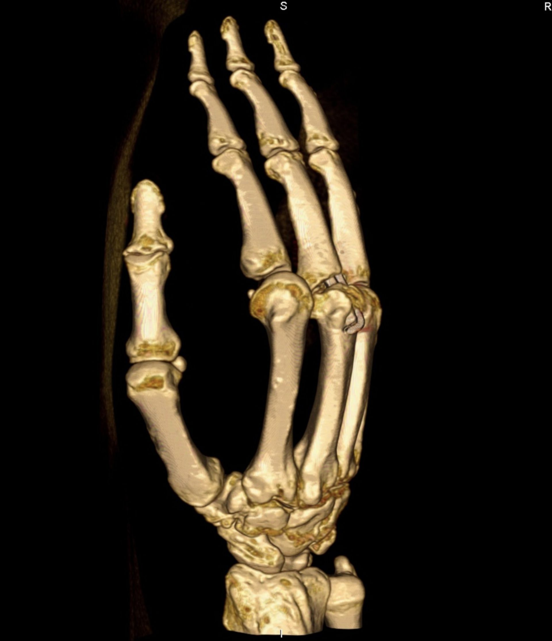 CT-scan: Reconstruction of the hand