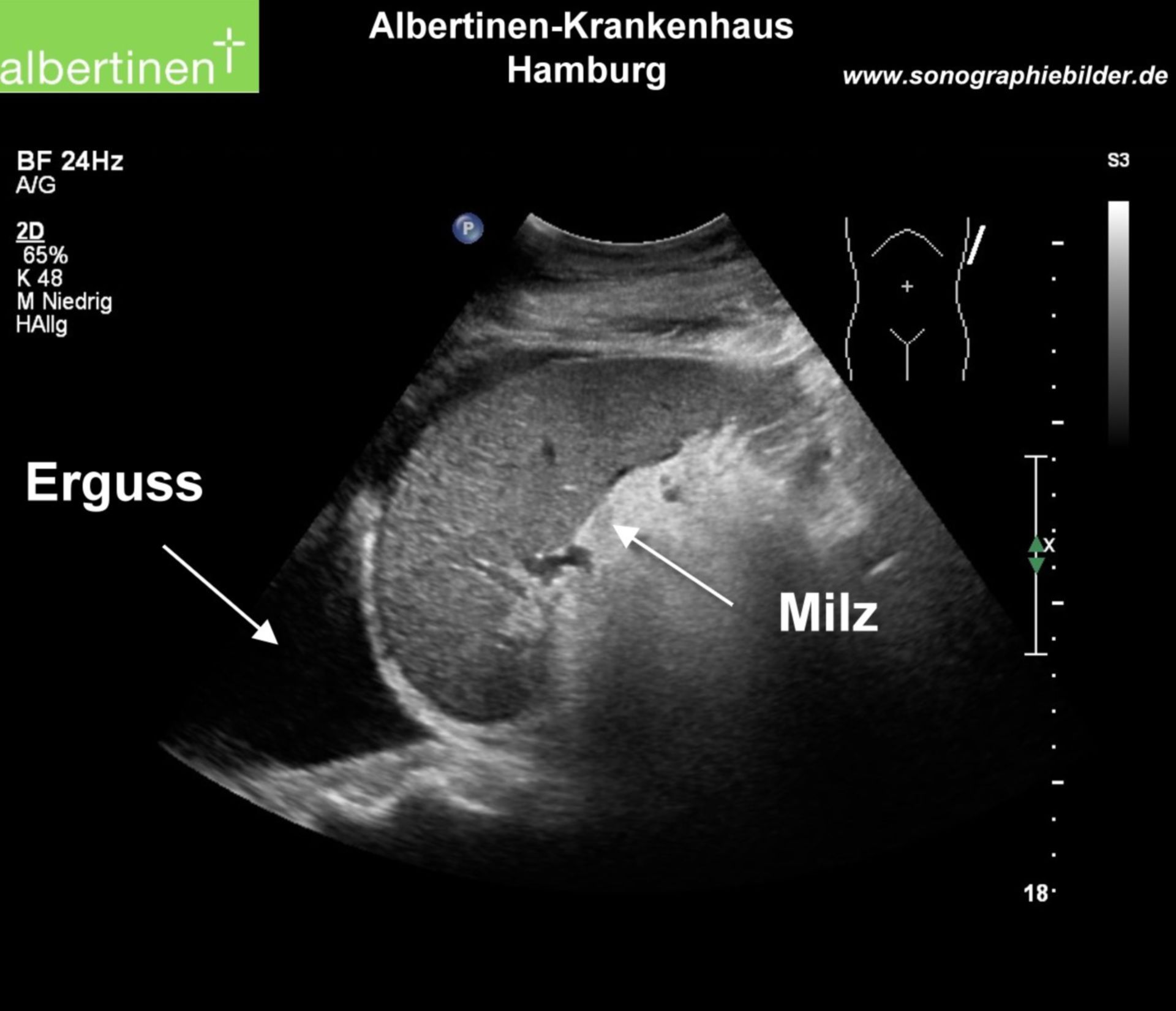 pleural effusion ultrasound