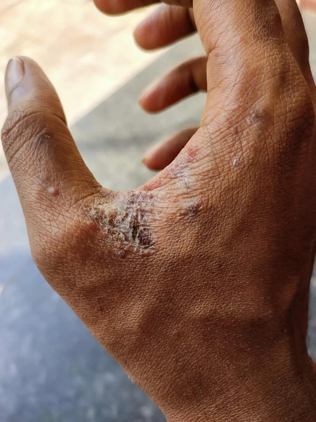 doccheck_-_04_-_skabies_bild1_hand_original.jpg