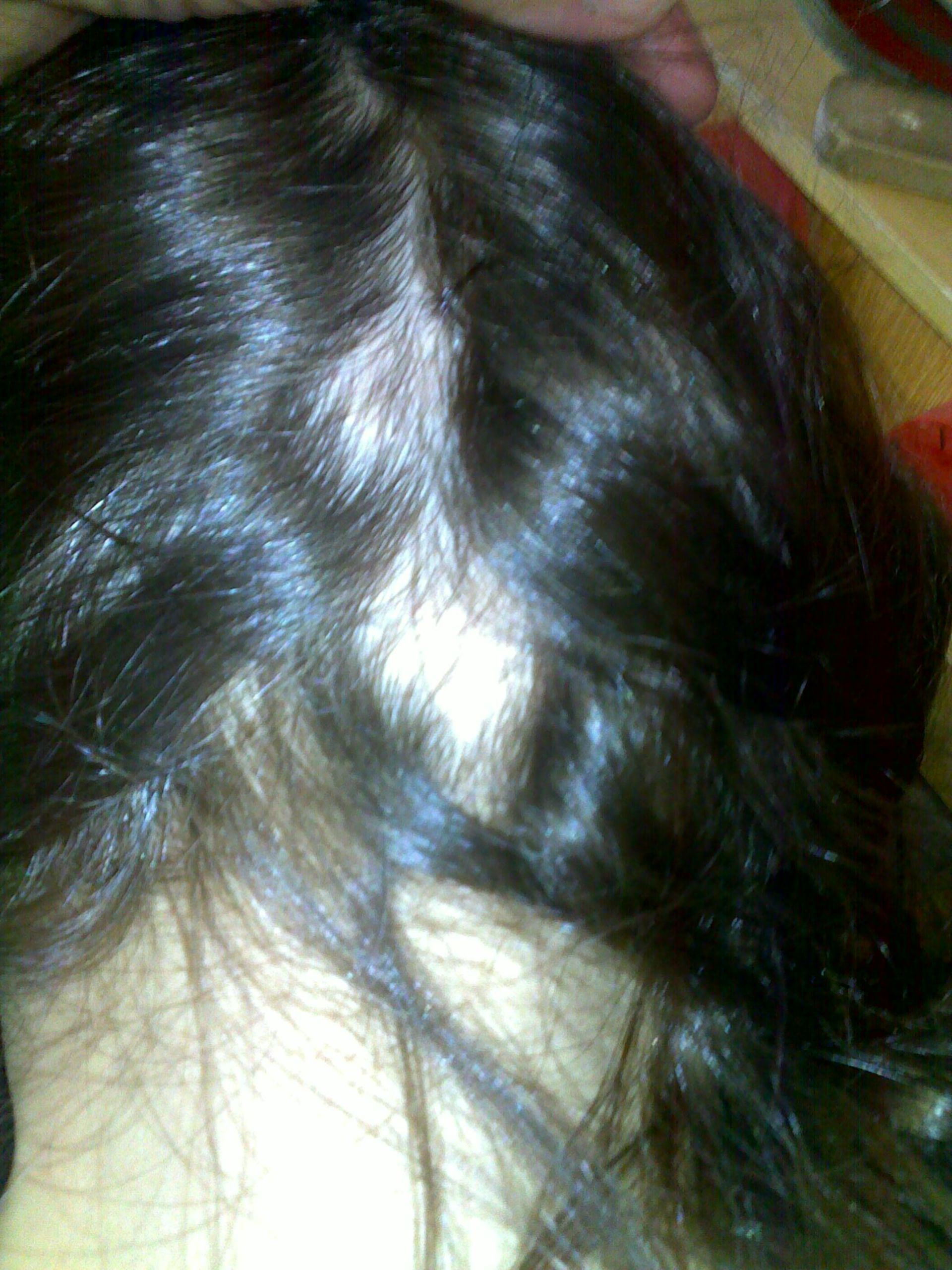 Alopezie 1