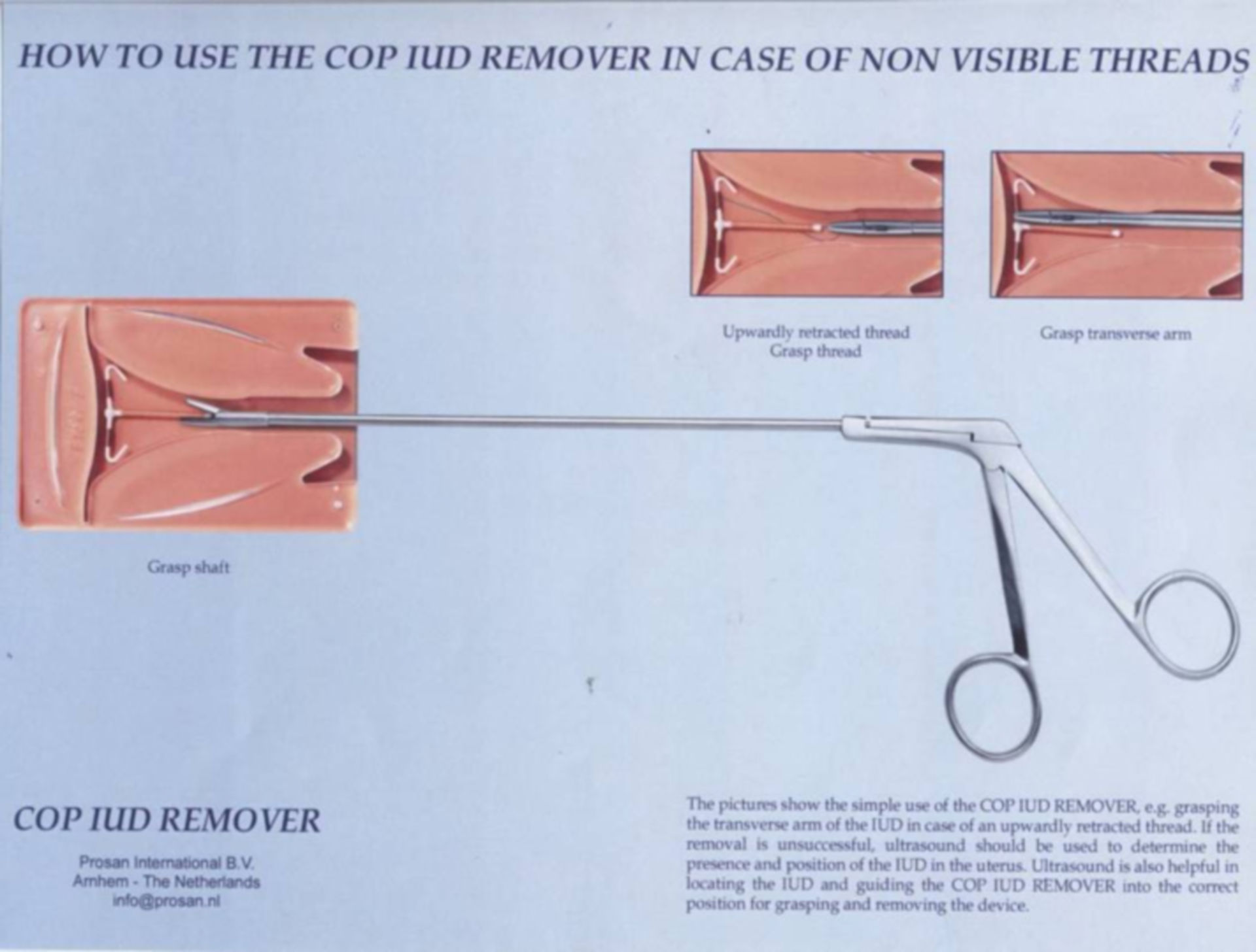 COP IUD Remover