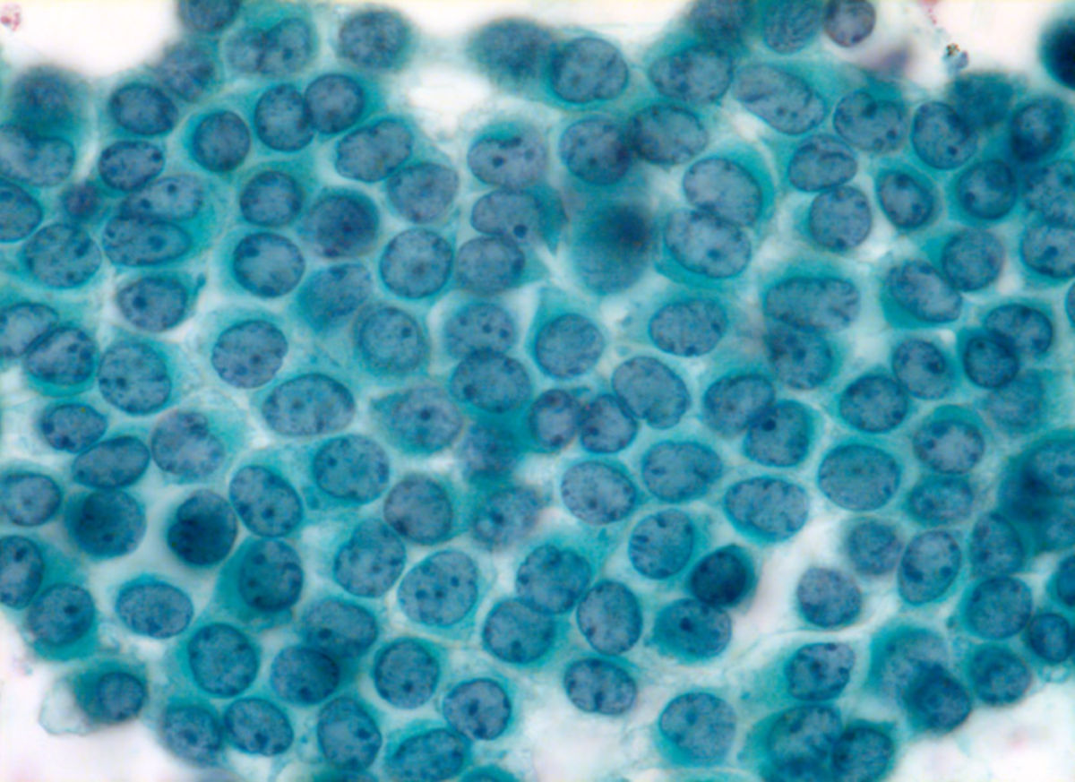 Normale Mesothelzellen (Peritoneum, Papanicolaou-Färbung)