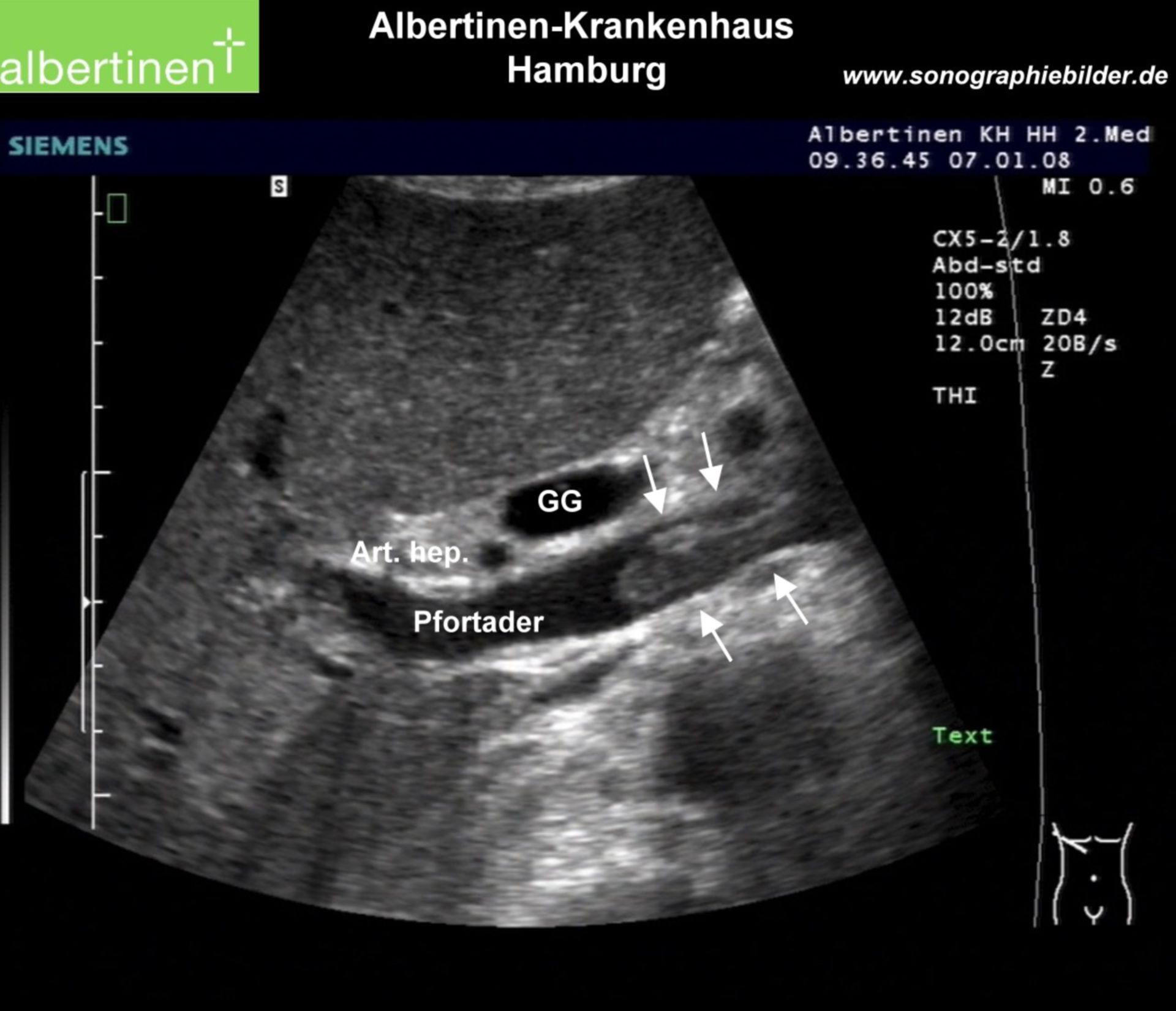 Sonography Thrombosis Of The Portal Vein DocCheck