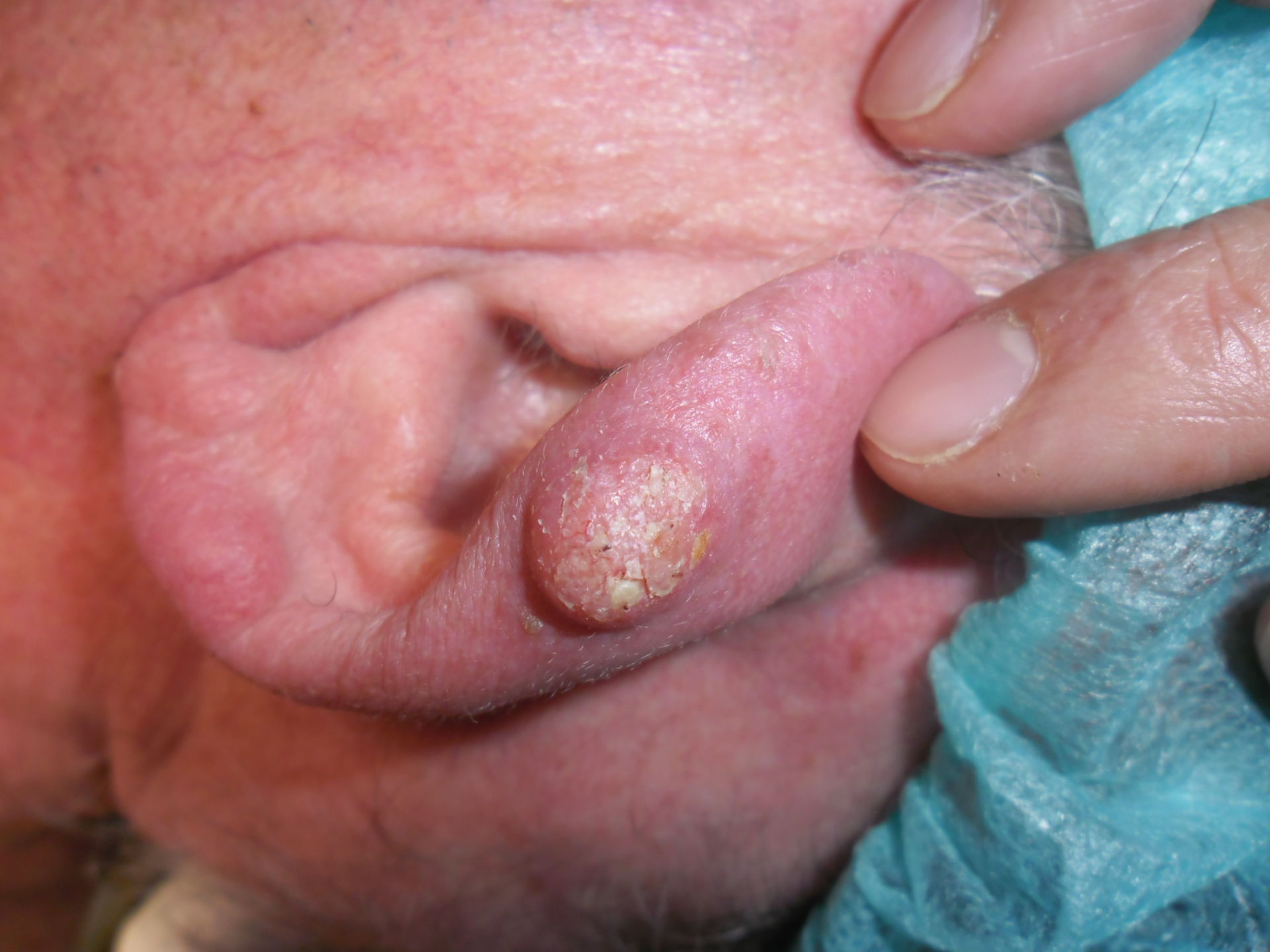 Carcinoma basocelular nodular en la oreja