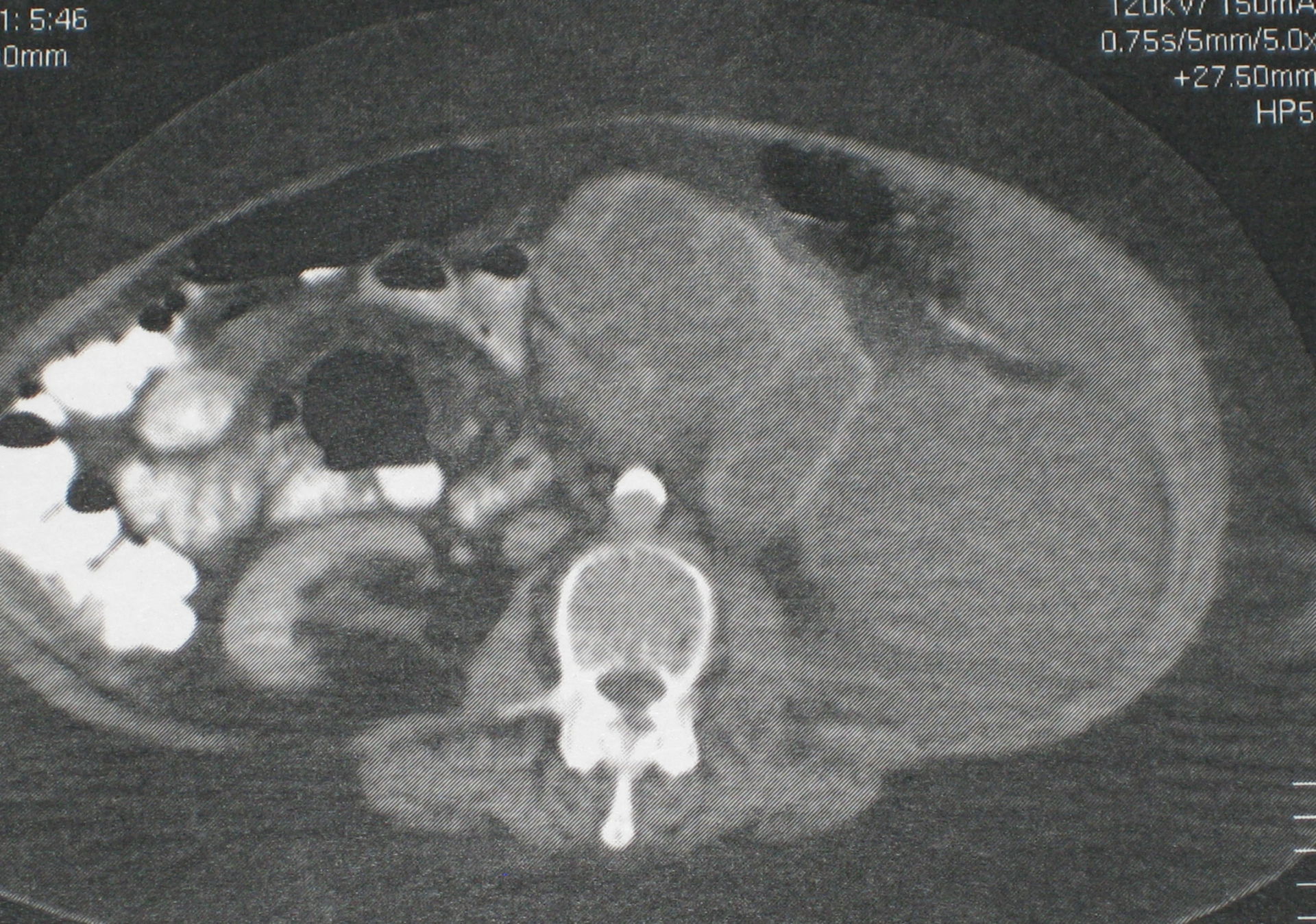 Pyonephrosis left kidney - CT scan