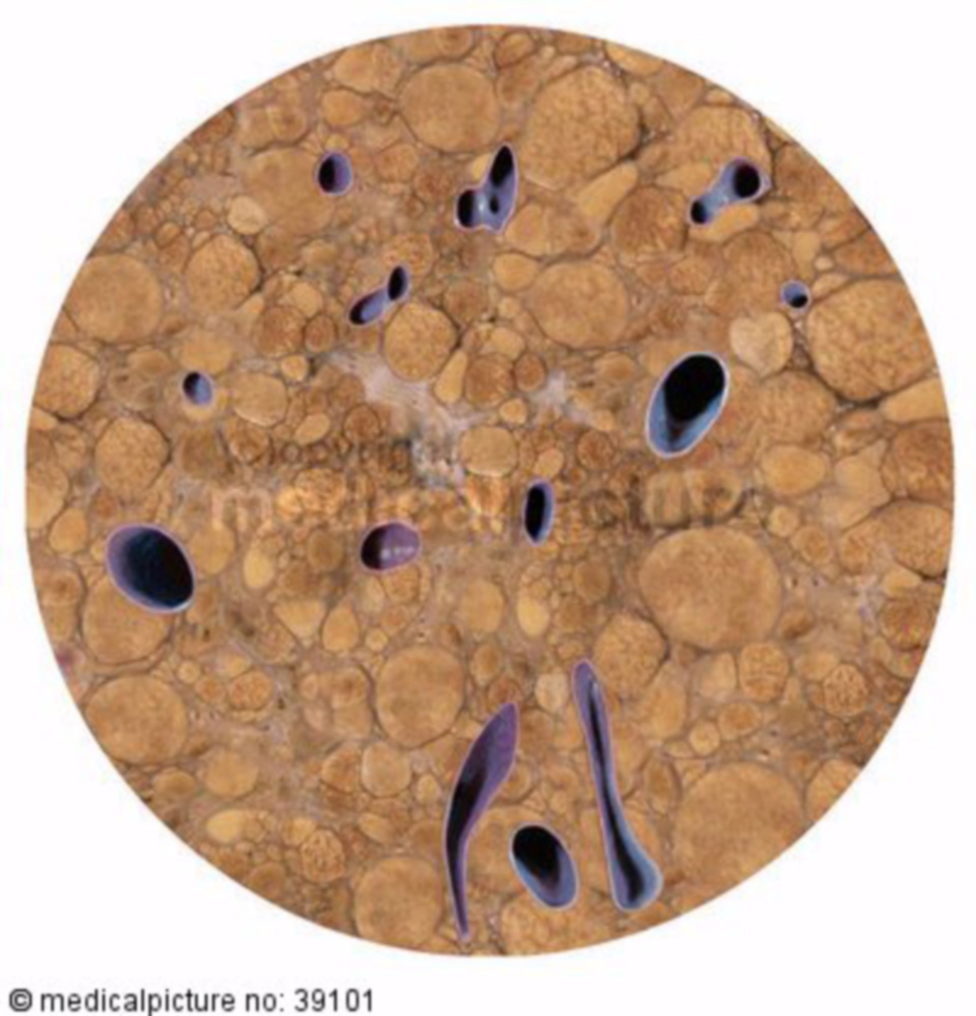  Schnittfläche einer zirrhotischen Leber 

