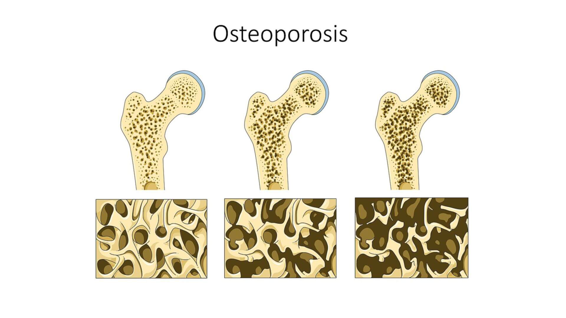 Osteoporose