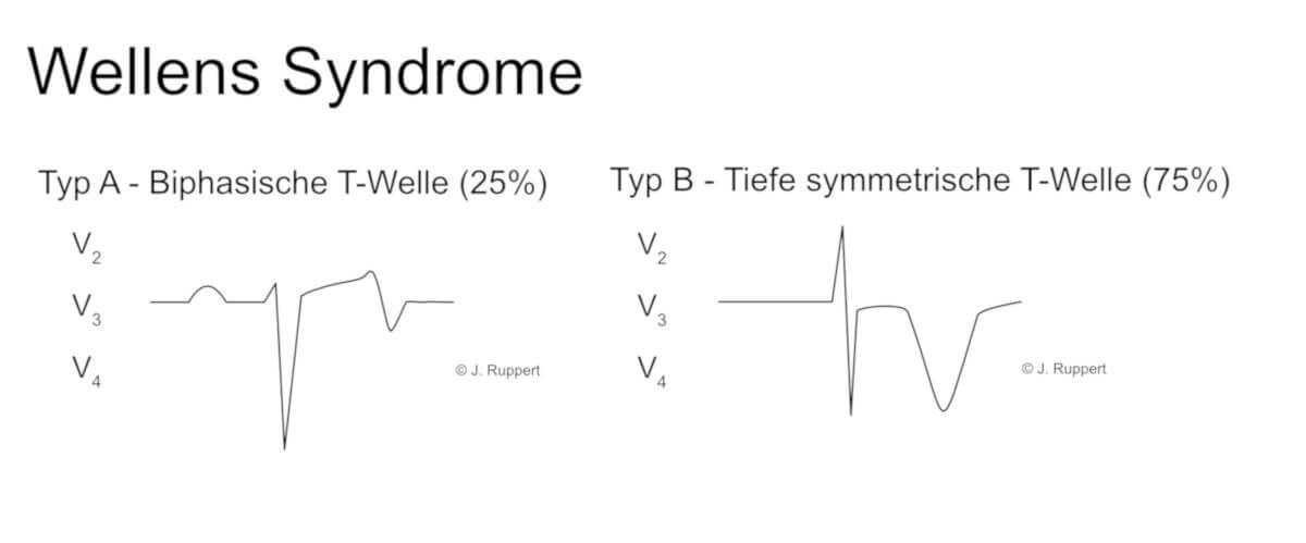 EKG-Veränderungen bei Wellens-Syndrom