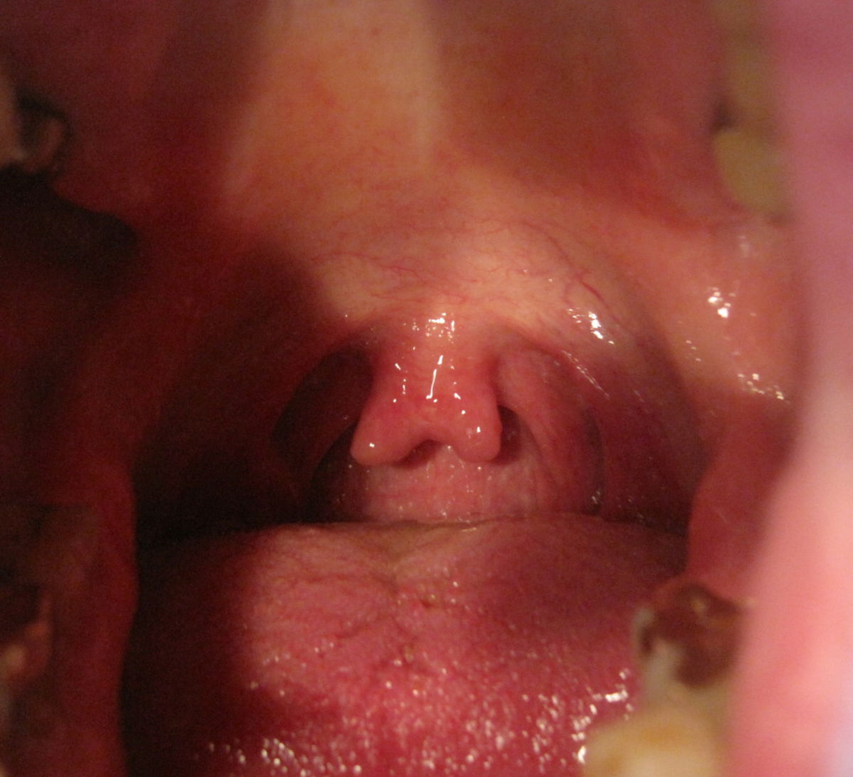 Uvula bifida