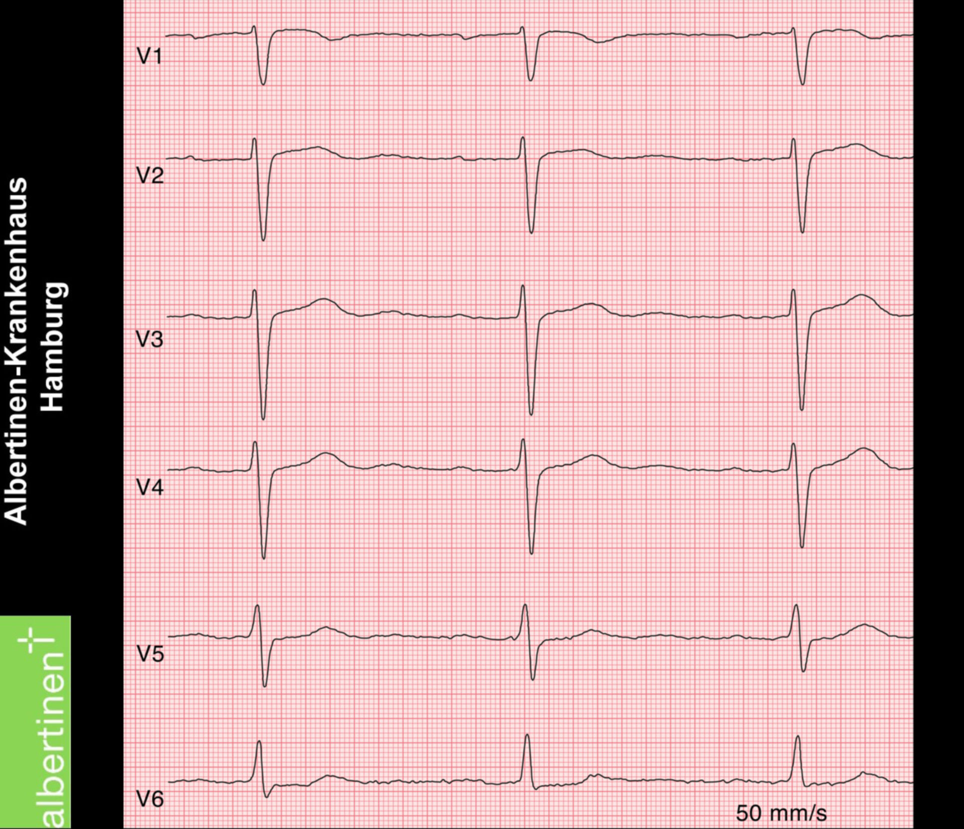 Blocco AV di primo grado (ECG)