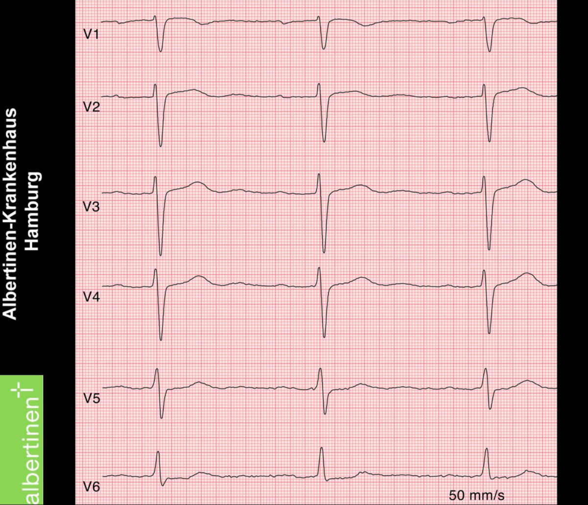 AV-Block 1. Grades (EKG)