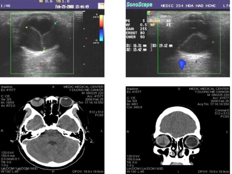 Pseudozyste unter der Netzhaut DocCheck