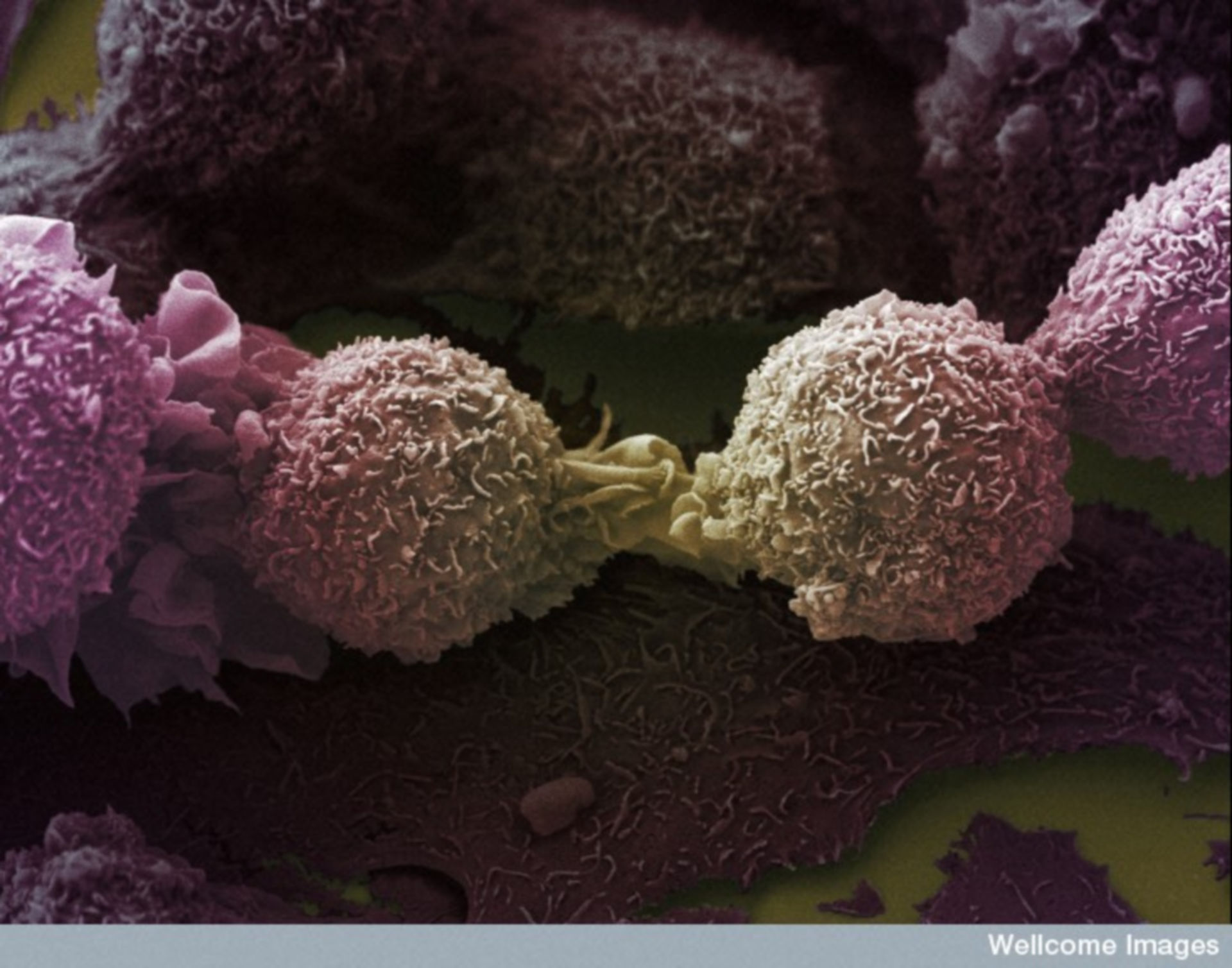 Find this and other great images in the Technology Networks new The Spectacular World of Cancer Cell Imaging Flipbook. Image of the Week – February 11, 2019 - CIL:39107 - http://www.cellimagelibrary.org/images/39107