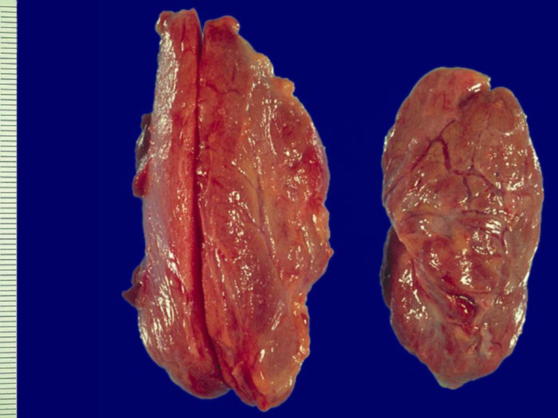 Amyloidose (normaler Schilddrüsenlappen rechts)
