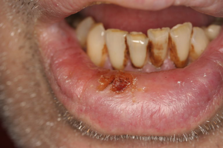 cigarette burn on lip treatment Lip burn