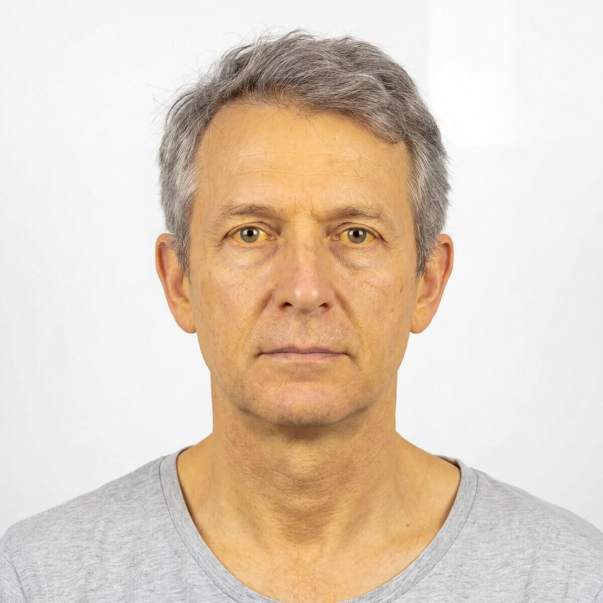 Ikterus
