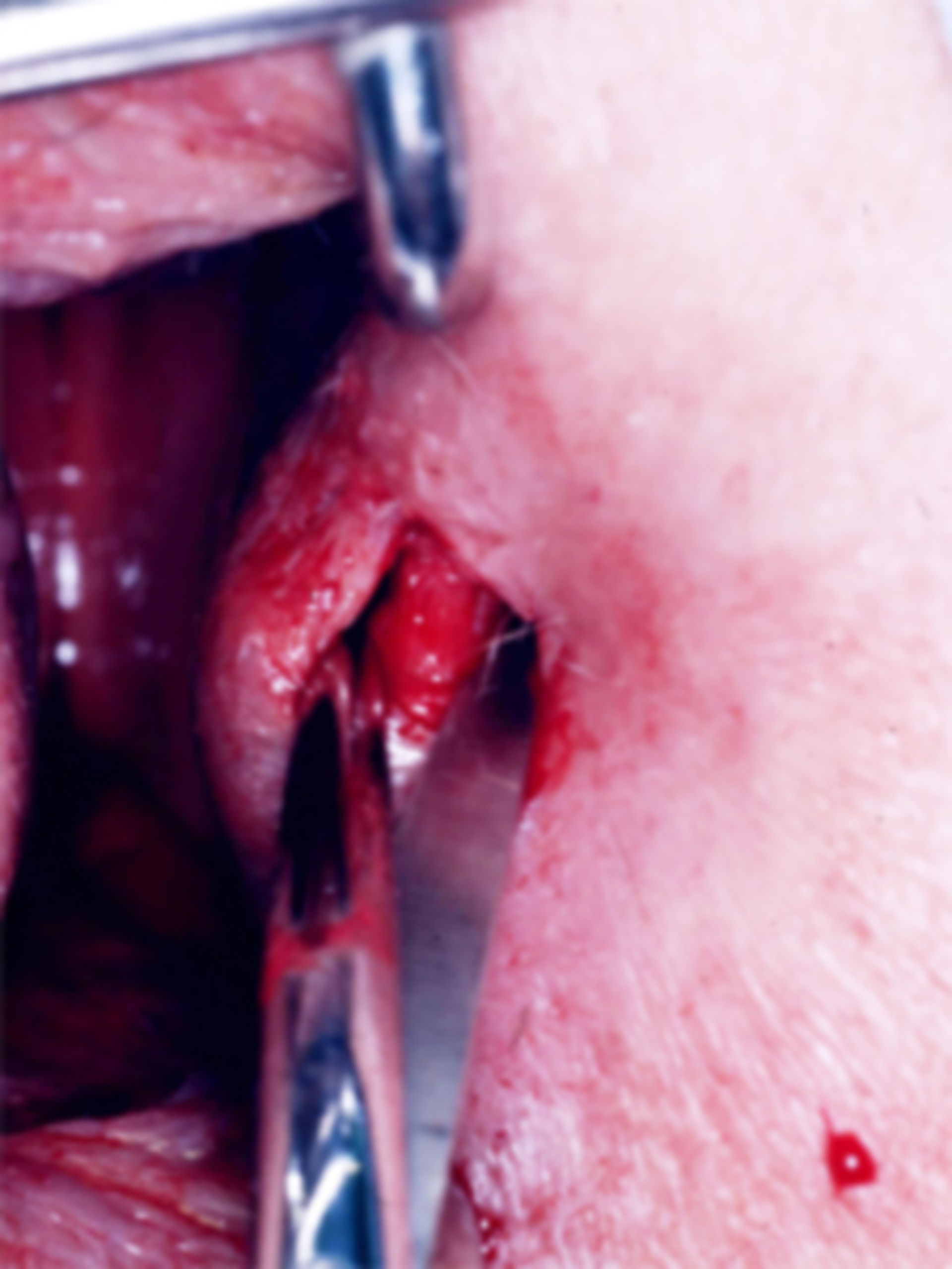 Anal Fissure: Surgical Therapy