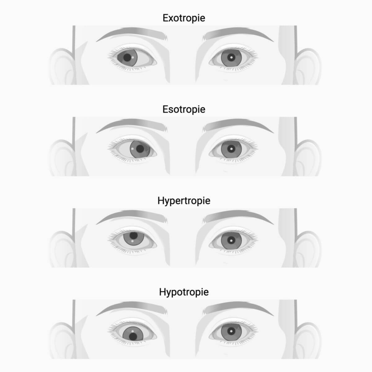 Strabismus