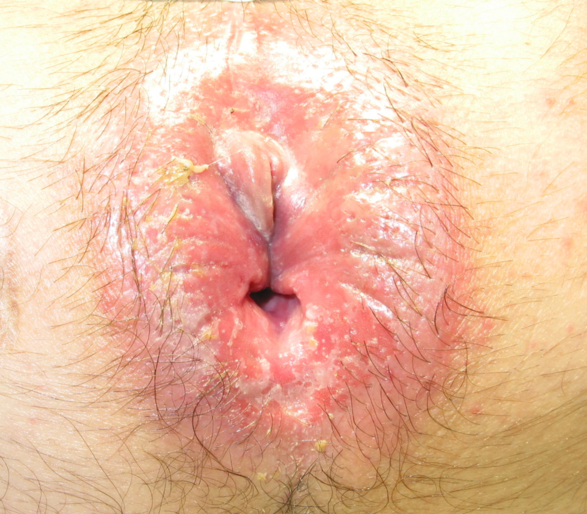Anal eczema and fissure