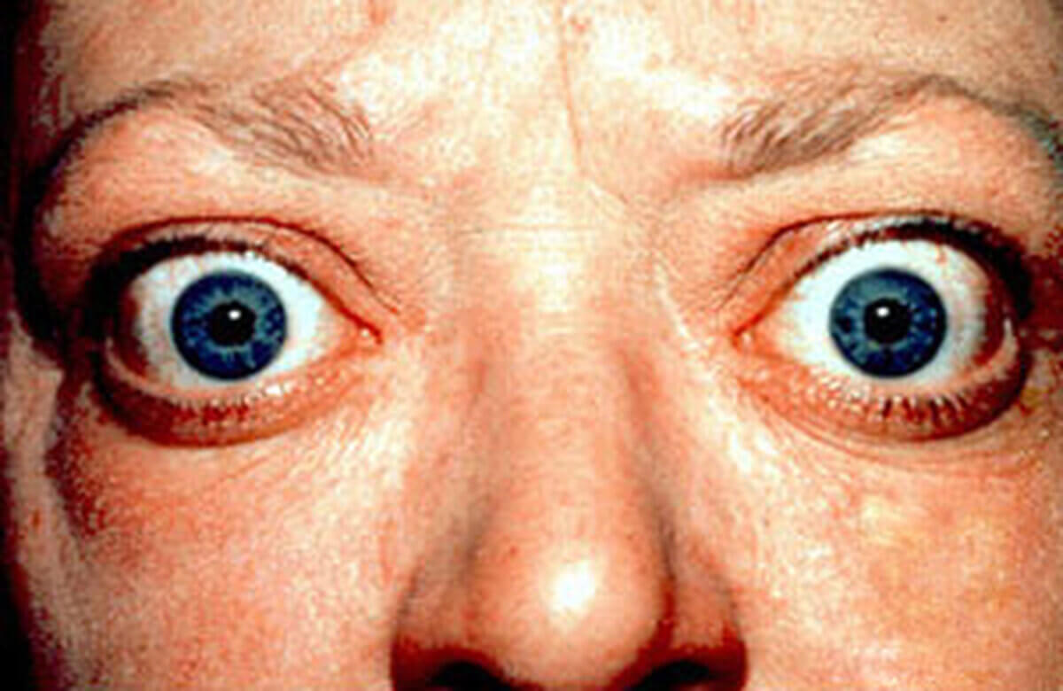 Exophthalmus bei Morbus Basedow