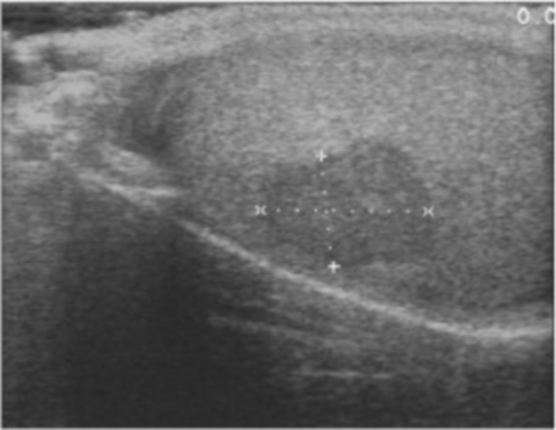 Testicular tumor (sonography)