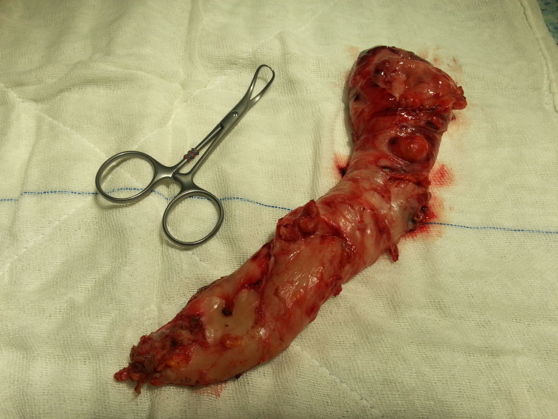 Removed stomach after gastric plication