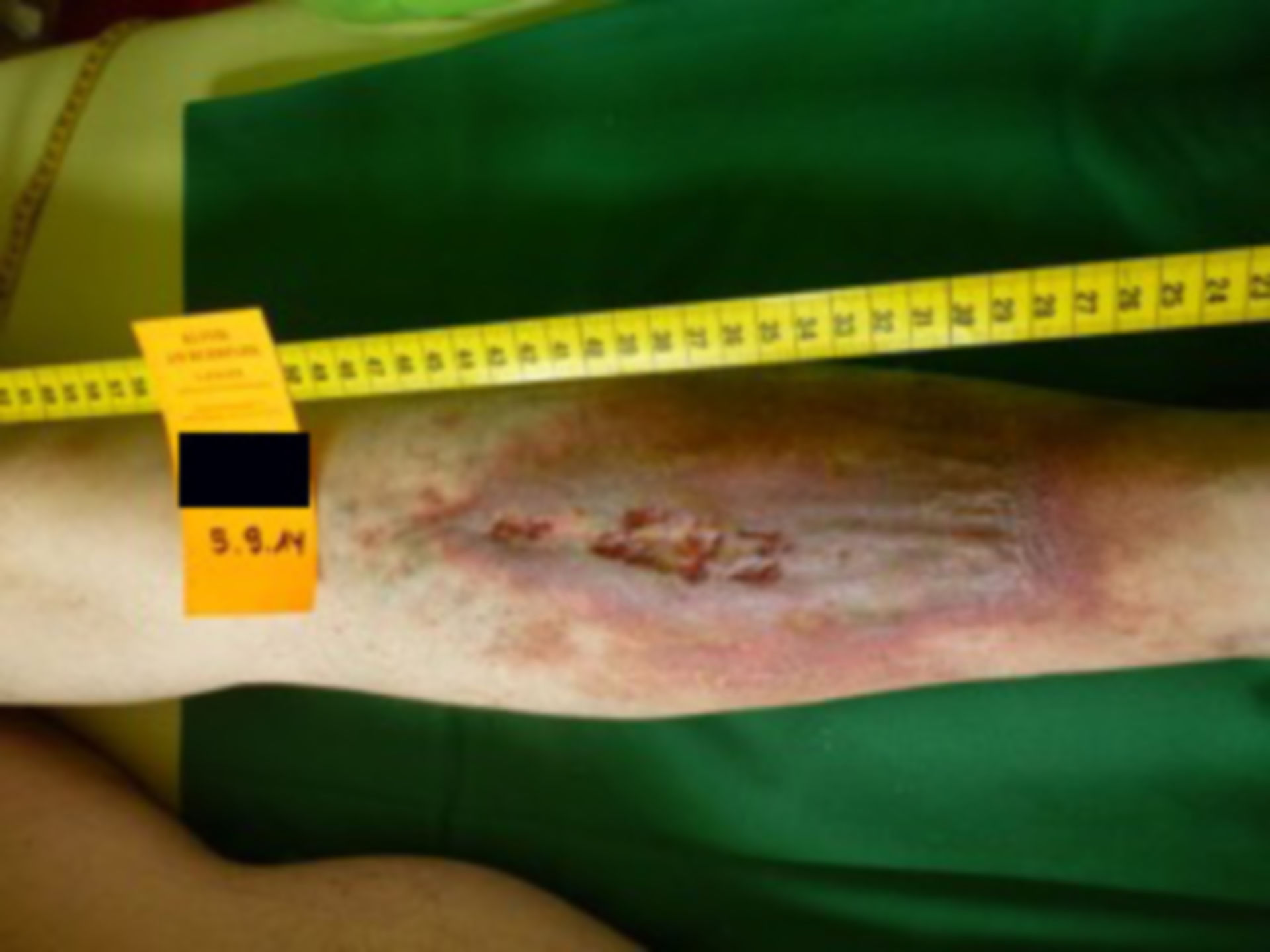 Úlcera de la pierna - abierta por 20 años: después de 3 días de terapia de compresión 3x/día (7)