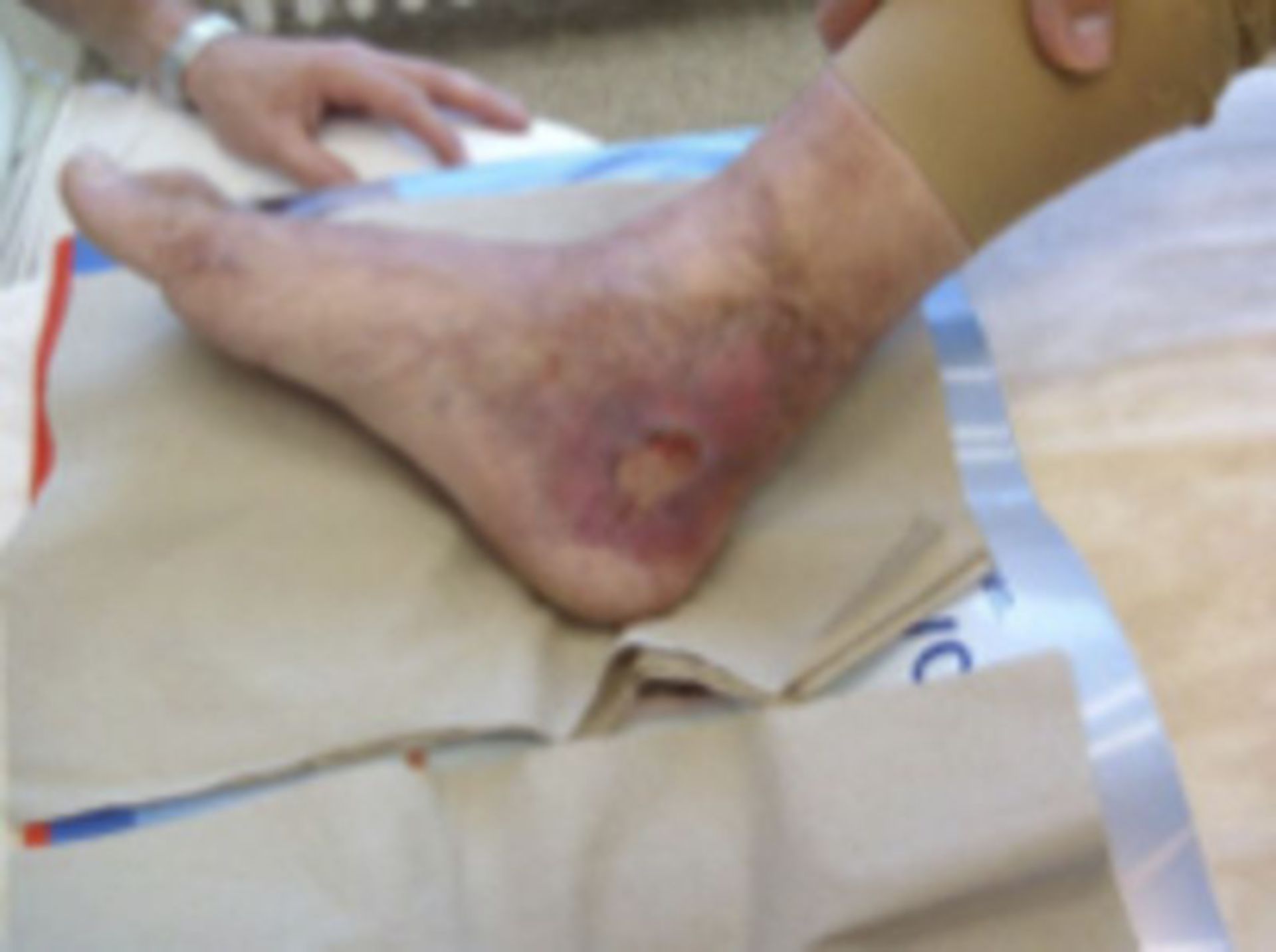 Open leg after repeated fractures (3)